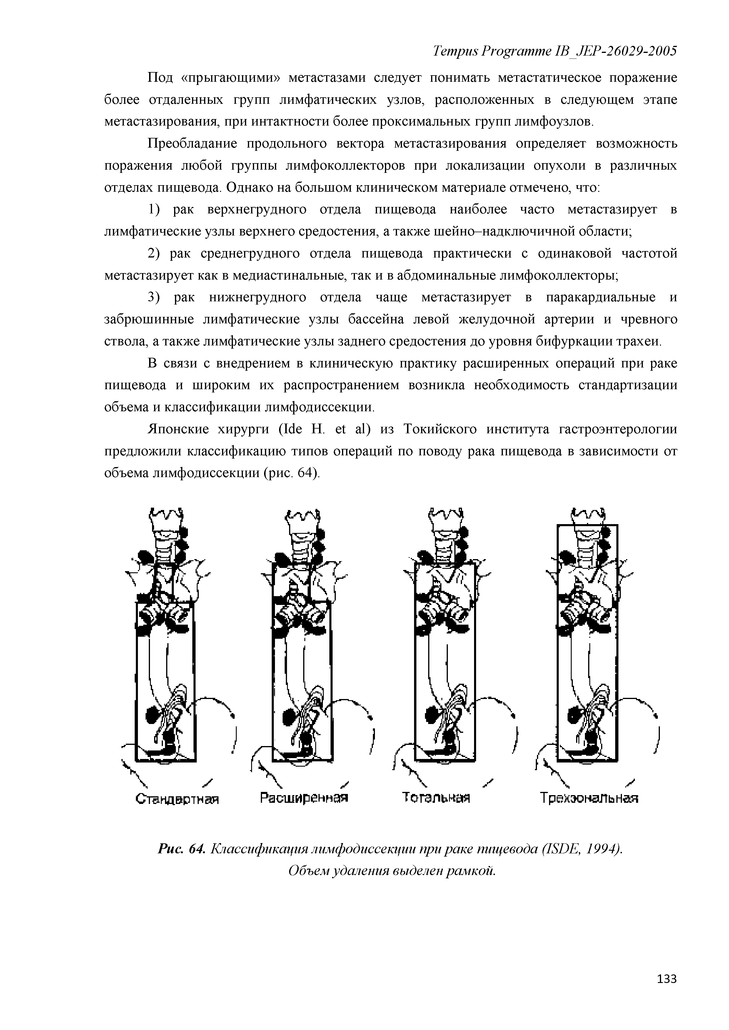 Рис. 64. Классификация лимфодиссекции при раке пищевода (1В1)Е, 1994). Объем удаления выделен рамкой.