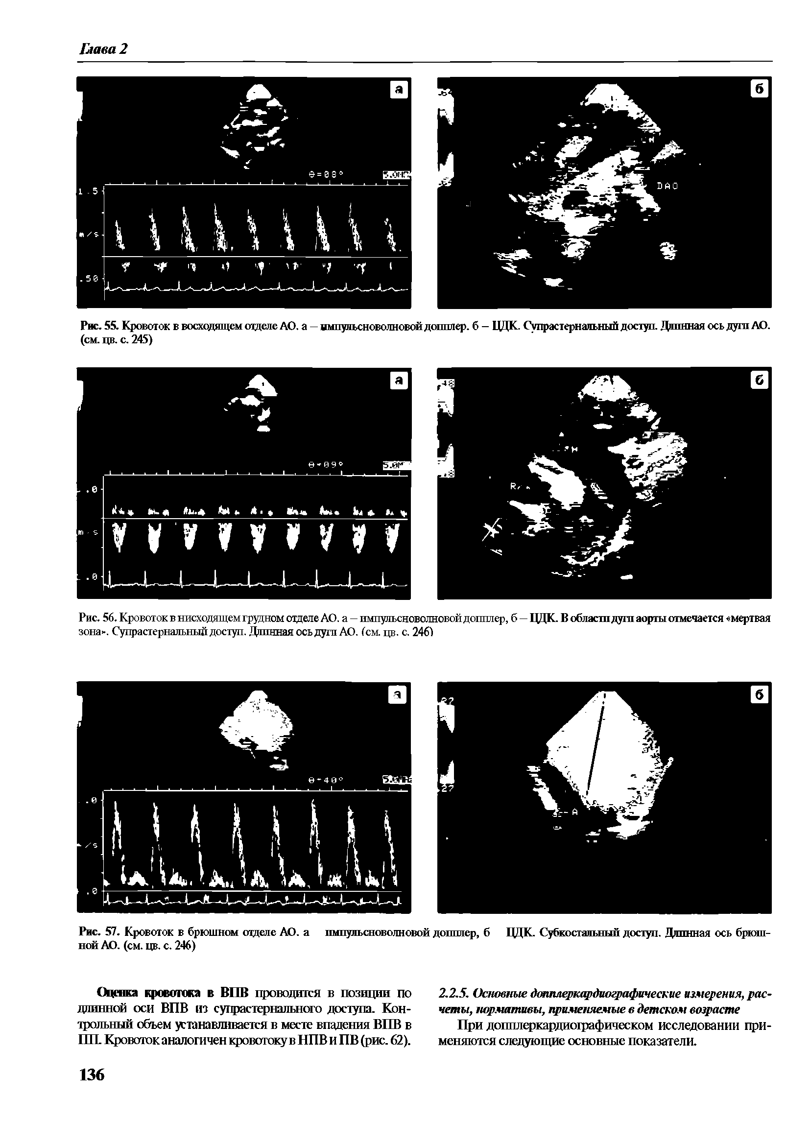 Рис. 56. Кровоток в нисходящем грудном отделе АО. а — импульсноволновой допплер, б — ЦДК. В области дуги аорты отмечается мертвая зона . Супрэстернальный доступ. Длинная ось дуга АО. Сем цв. с. 246)...
