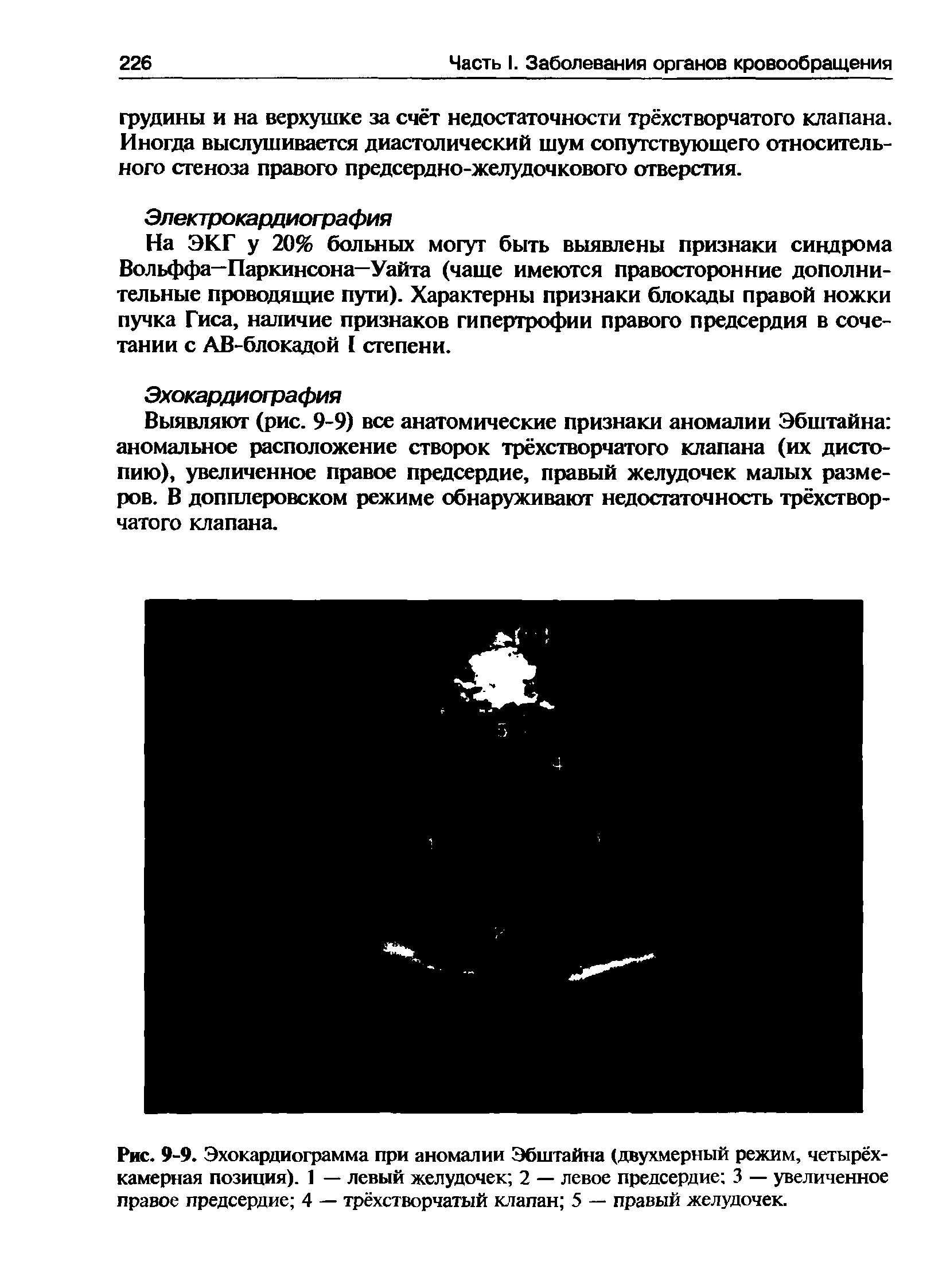 Рис. 9-9. Эхокардиограмма при аномалии Эбштайна (двухмерный режим, четырёхкамерная позиция). 1 — левый желудочек 2 — левое предсердие 3 — увеличенное правое предсердие 4 — трёхстворчатый клапан 5 — правый желудочек.