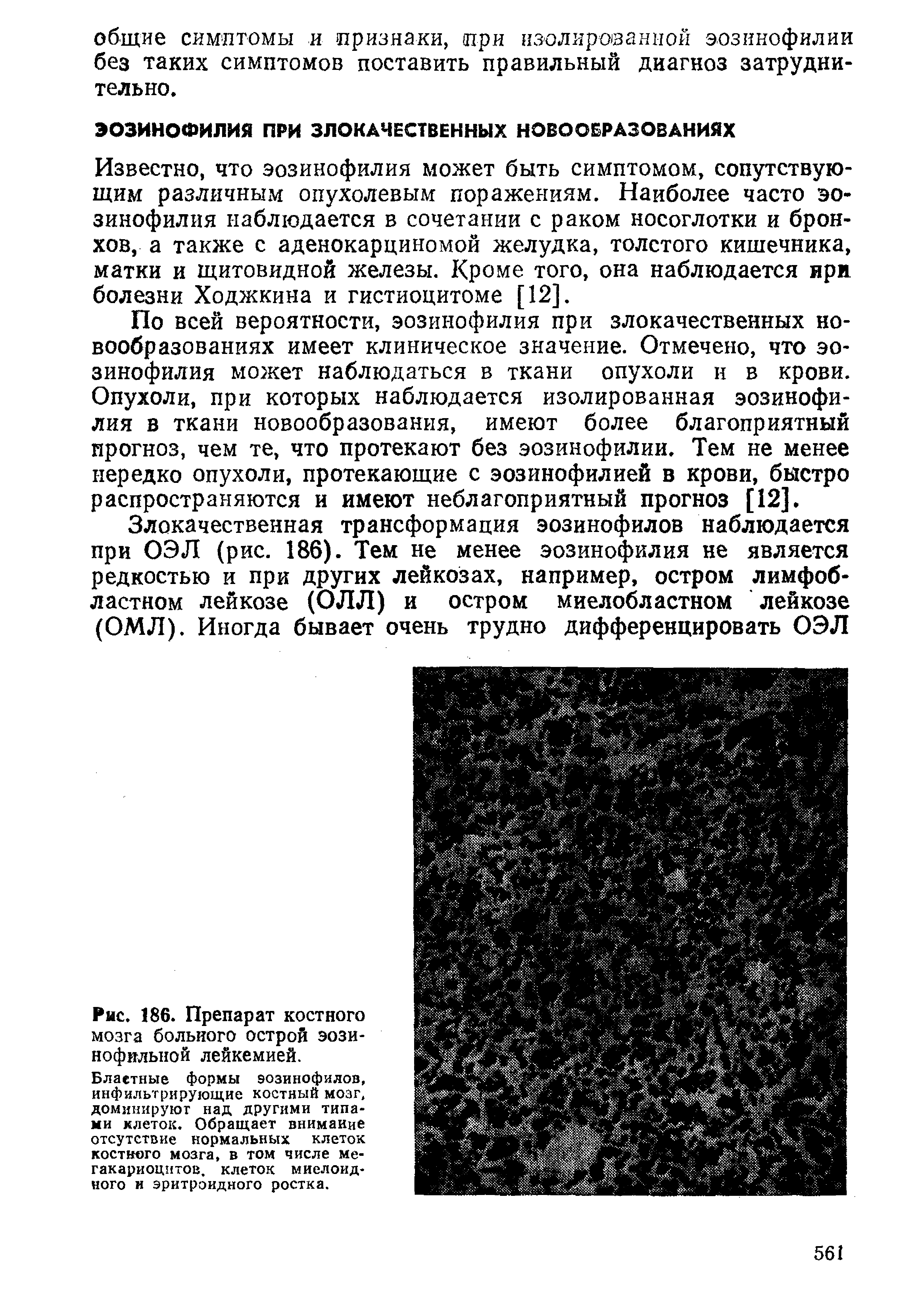 Рис. 186. Препарат костного мозга больного острой эозинофильной лейкемией.