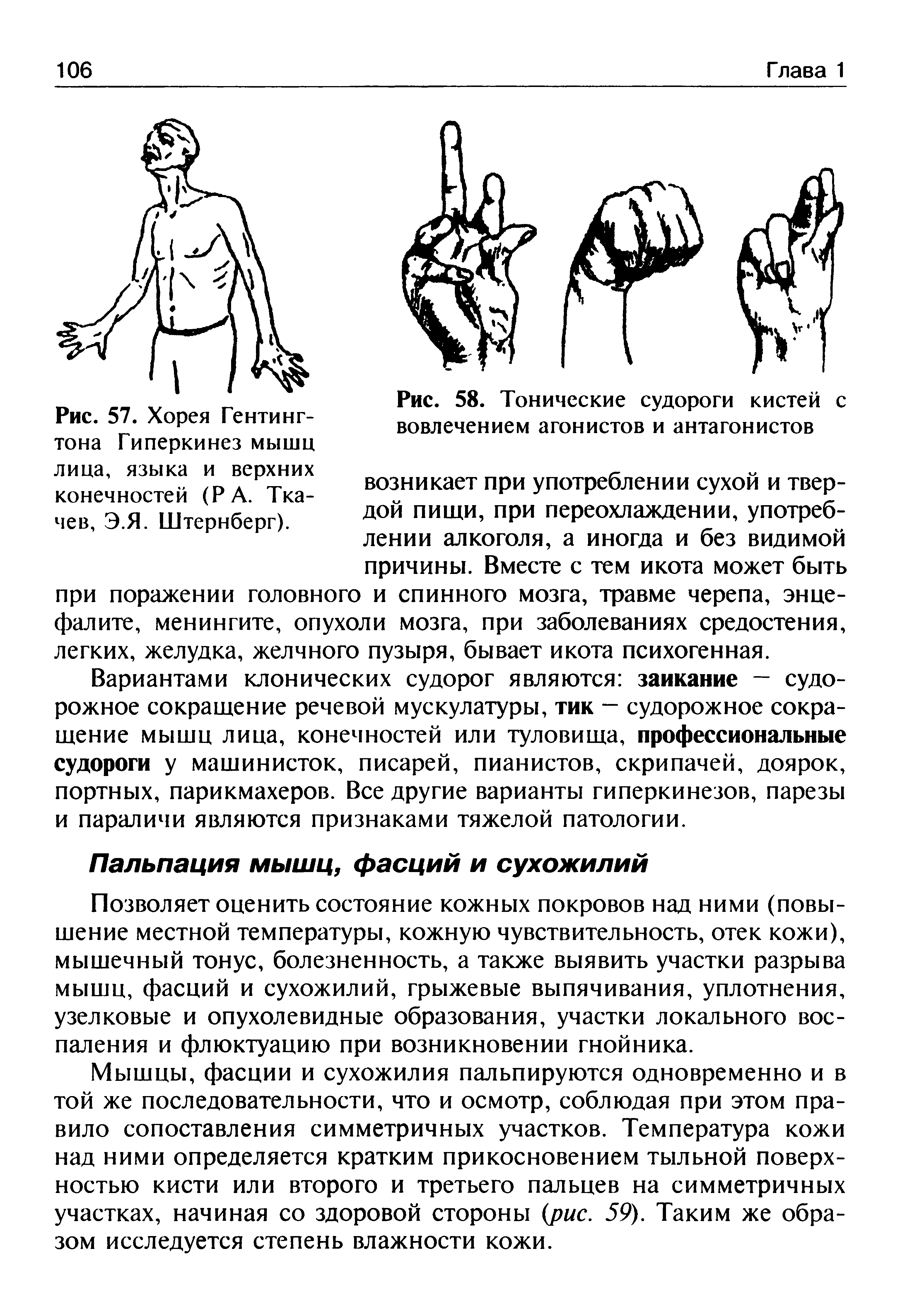 Рис. 58. Тонические судороги кистей с вовлечением агонистов и антагонистов...