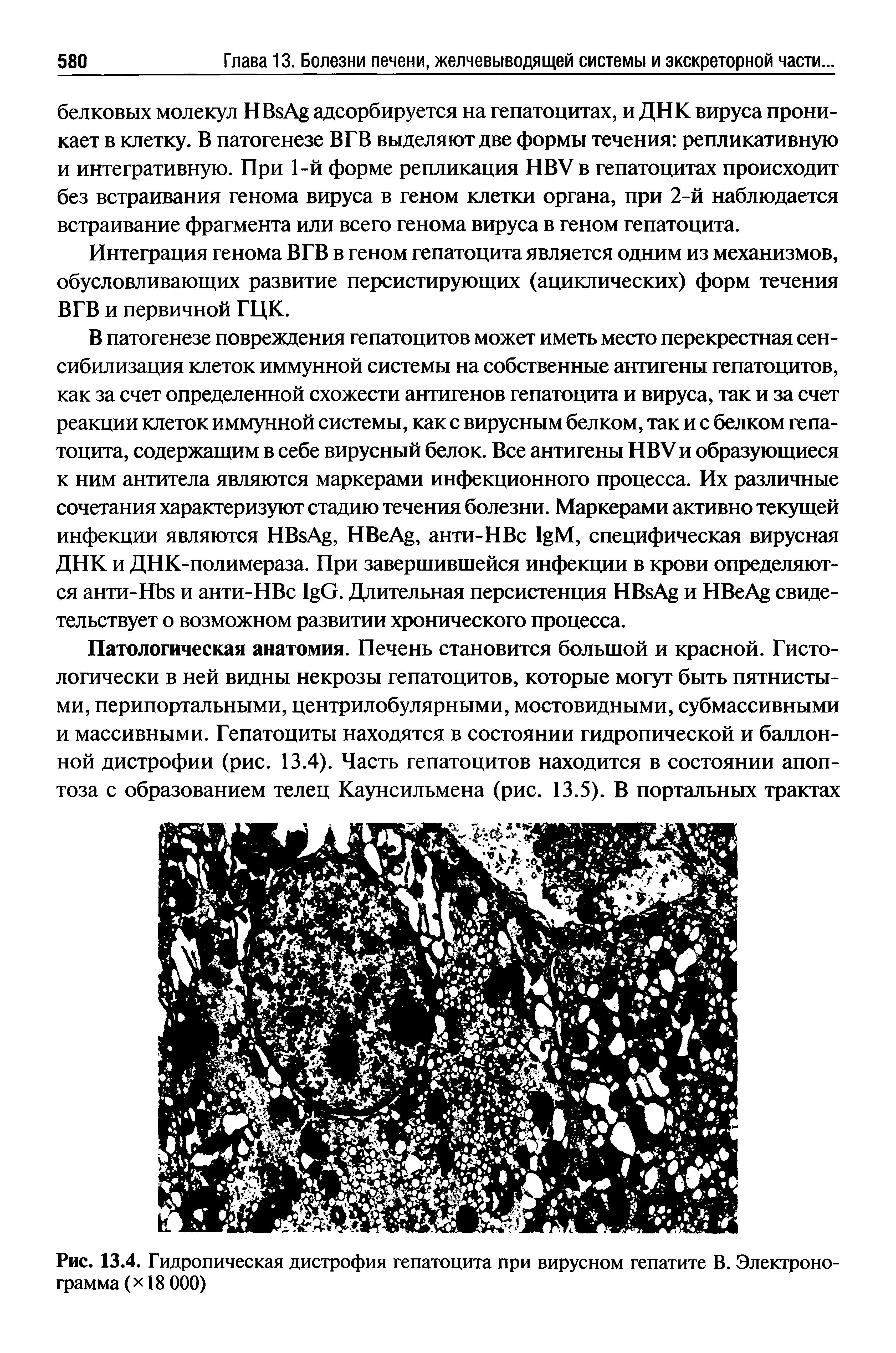 Рис. 13.4. Гидропическая дистрофия гепатоцита при вирусном гепатите В. Электроно-грамма( 18 000)...