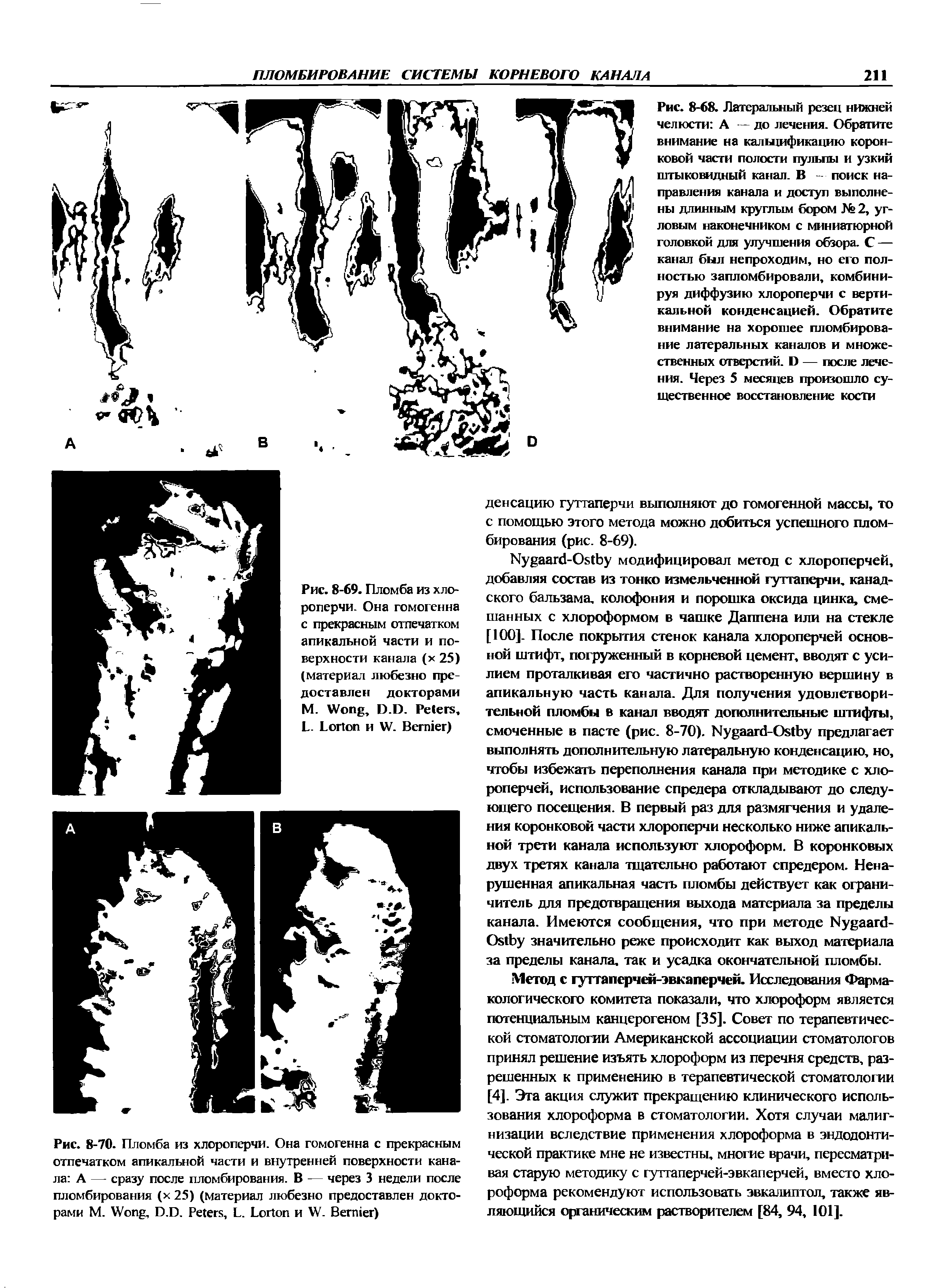 Рис. 8-69. Пломба из хлороперчи. Она гомогенна с прекрасным отпечатком апикальной части и поверхности канала (х 25) (материал любезно предоставлен докторами М. W , D.D. P , L. L и W. B )...