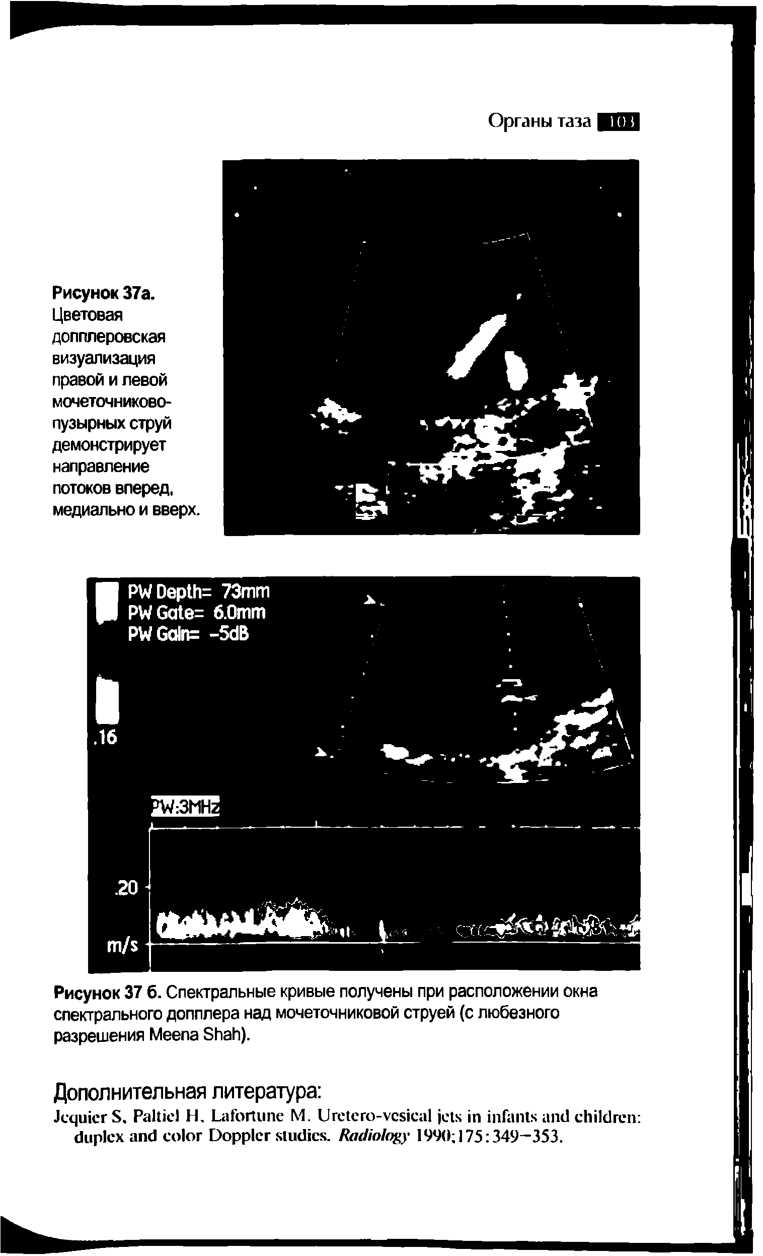 Рисунок 37 6. Спектральные кривые получены при расположении окна спектрального допплера над мочеточниковой струей (с любезного разрешения Меепа S ).