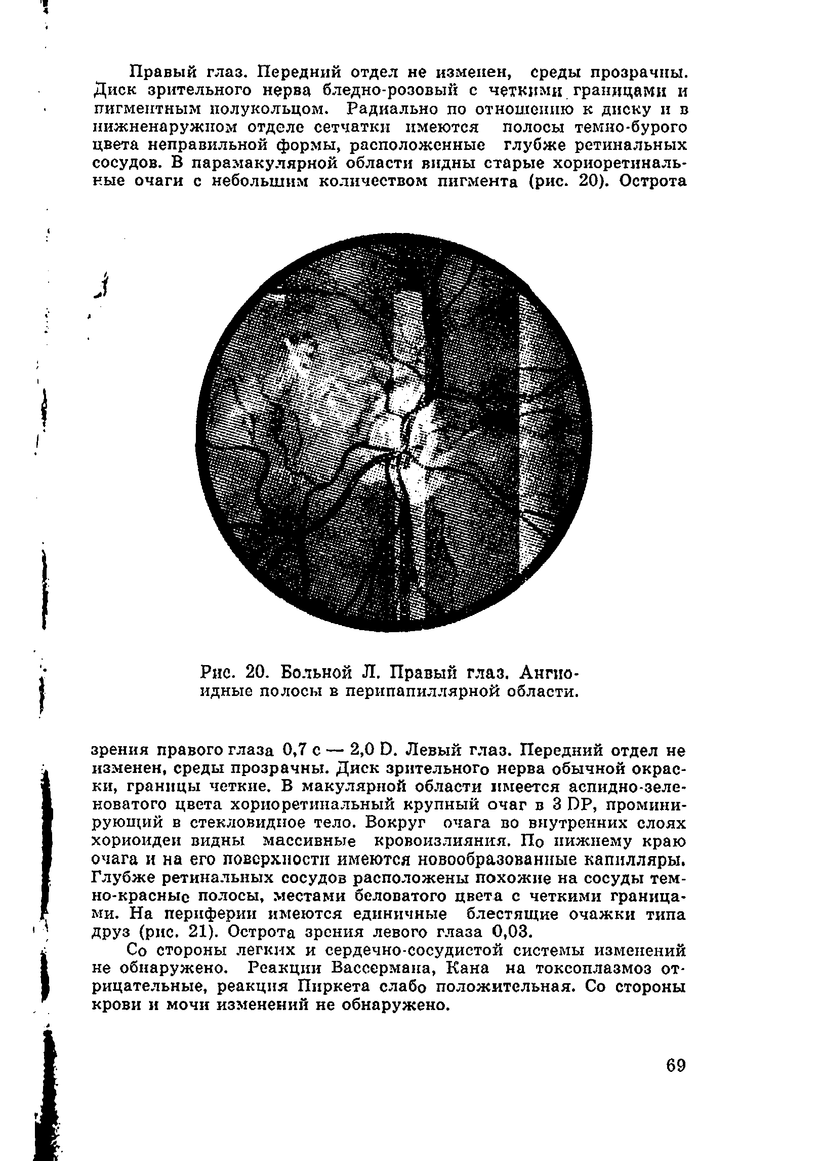 Рис. 20. Больной Л, Правый глаз. Ангио-идные полосы в перипапиллярной области.