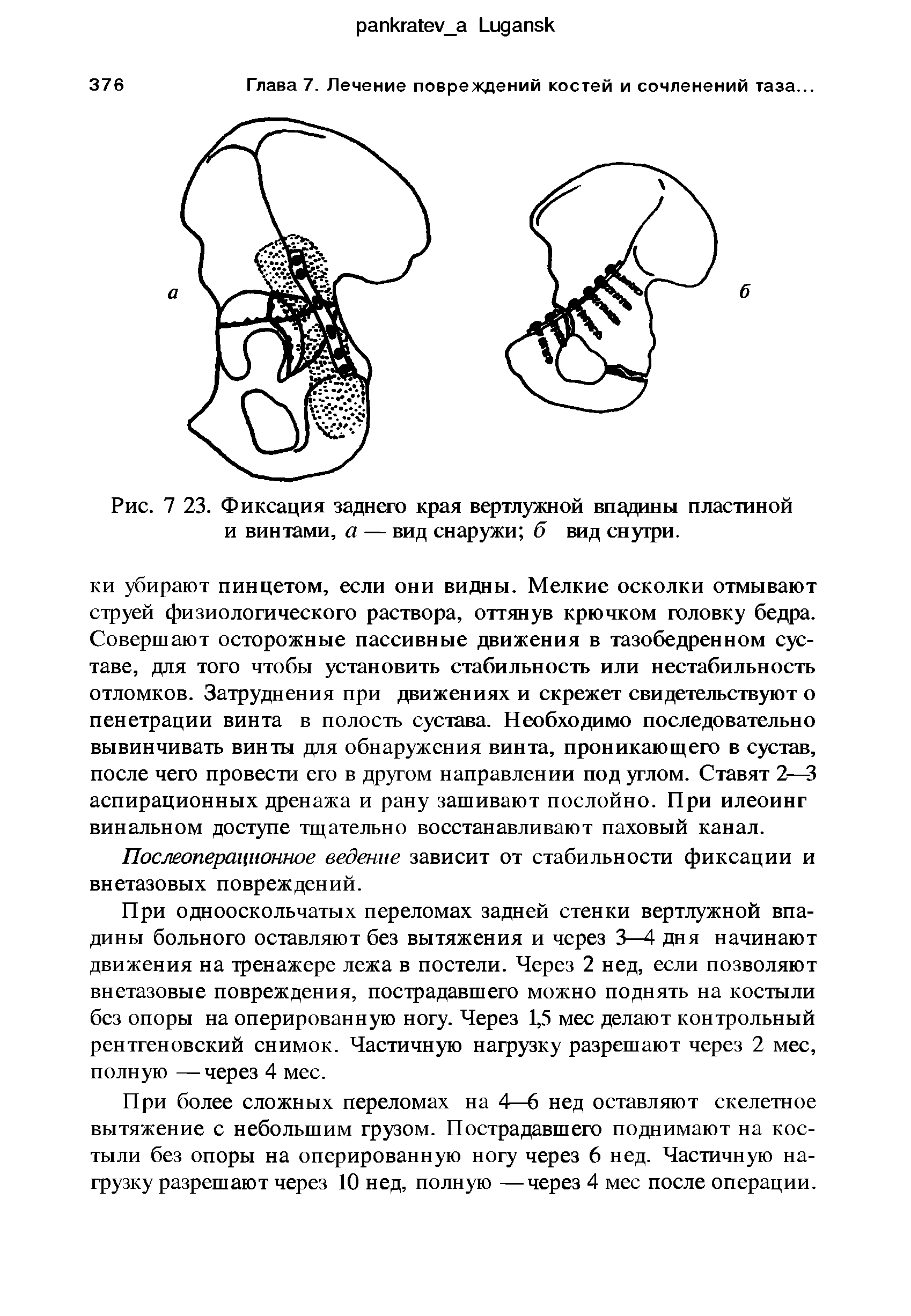 Рис. 7 23. Фиксация заднего края вертлужной впадины пластиной и винтами, а — вид снаружи б вид снутри.