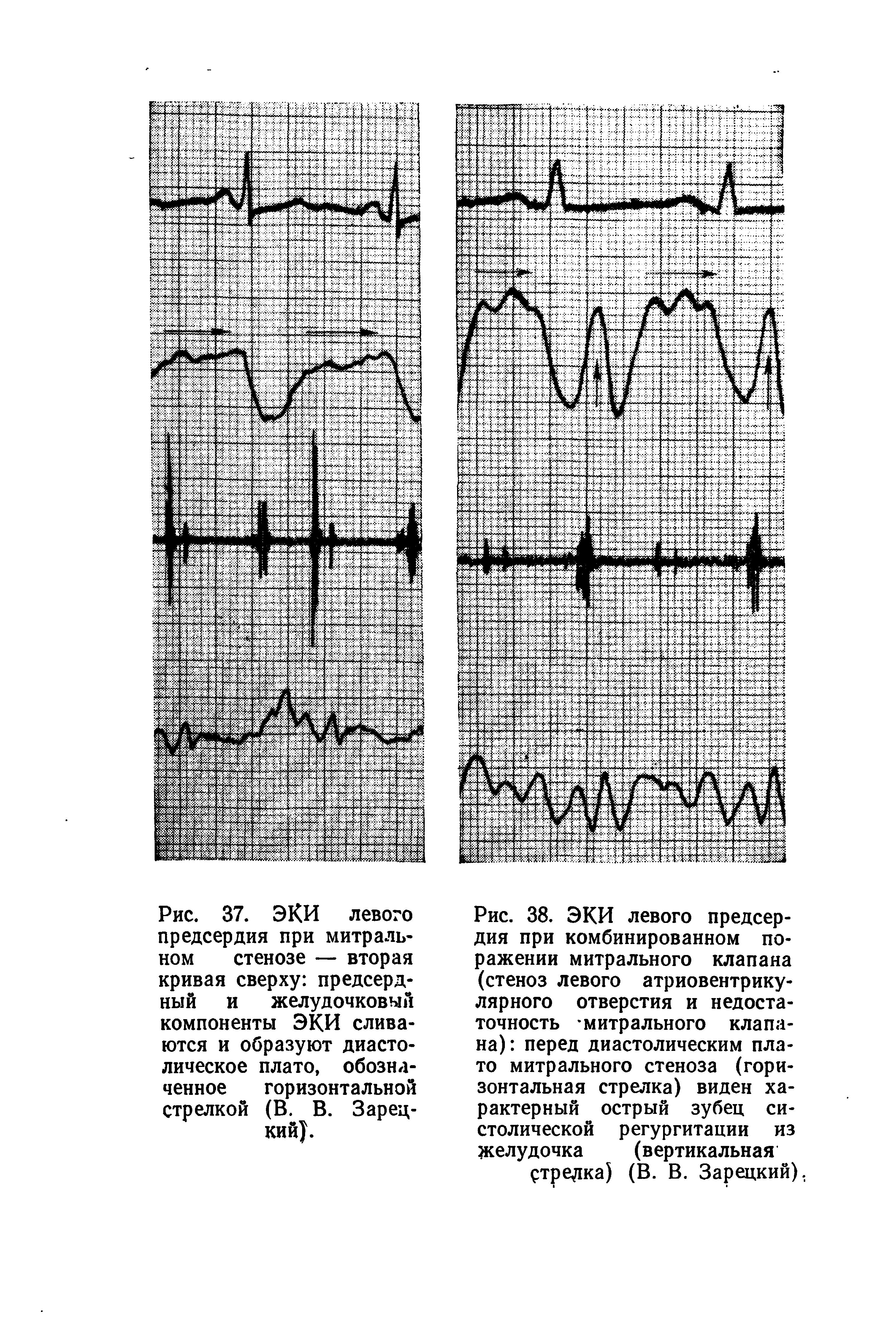 Рис. 38. ЭКИ левого предсердия при комбинированном поражении митрального клапана (стеноз левого атриовентрикулярного отверстия и недостаточность митрального клапана) перед диастолическим плато митрального стеноза (горизонтальная стрелка) виден характерный острый зубец систолической регургитации из желудочка (вертикальная...