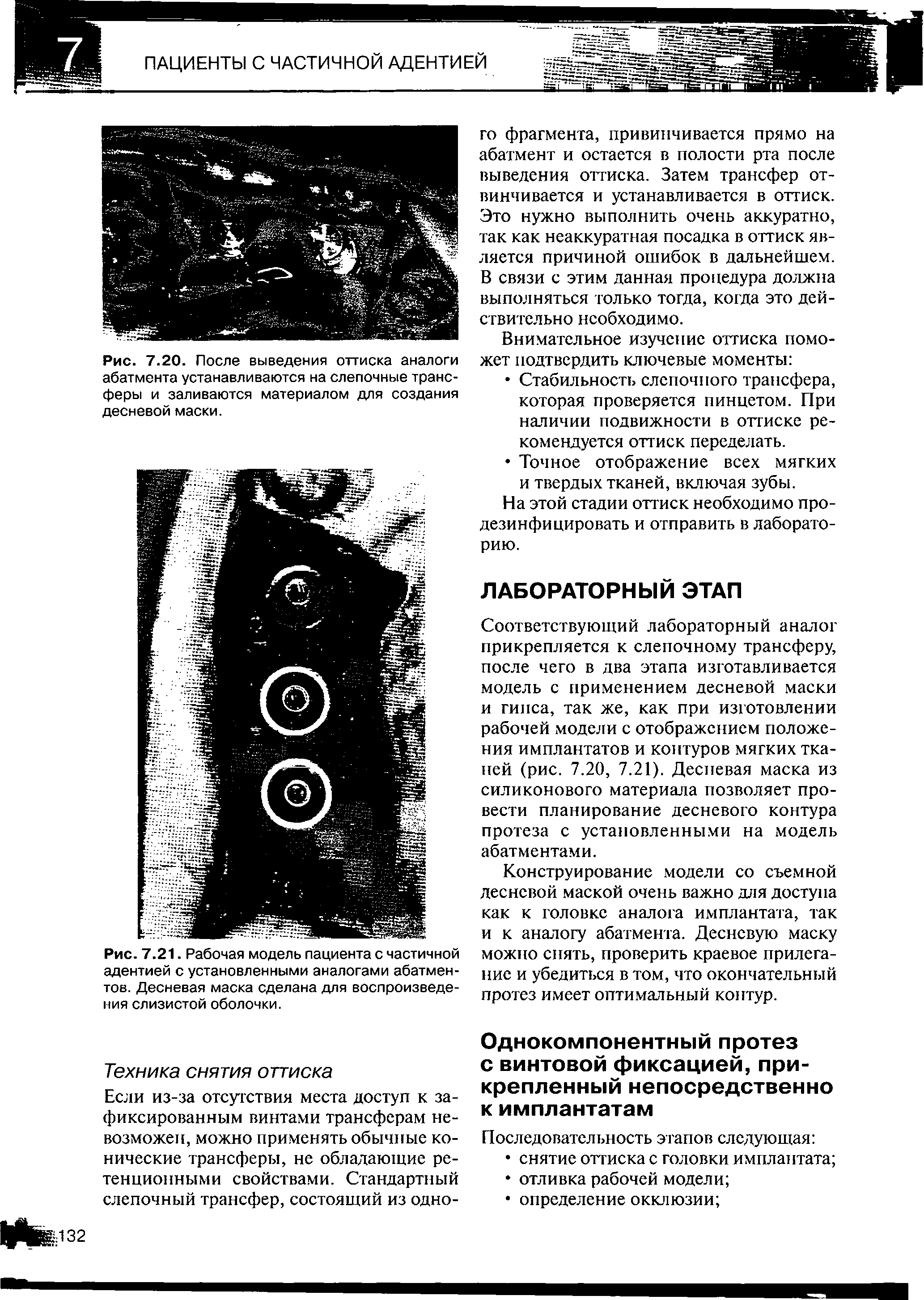 Рис. 7.21. Рабочая модель пациента с частичной адентией с установленными аналогами абатмен-тов. Десневая маска сделана для воспроизведения слизистой оболочки.