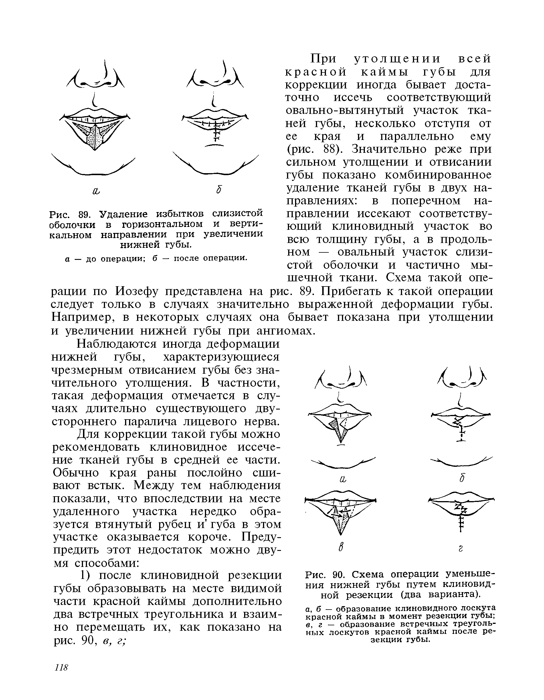 Рис. 90. Схема операции уменьшения нижней губы путем клиновидной резекции (два варианта).