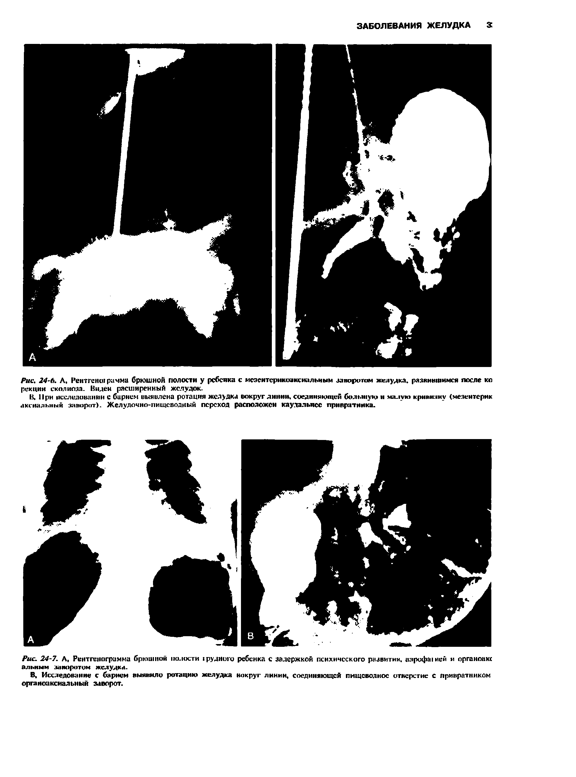Рис. 24-6. А, Рентгене рачма брюшной полости у ребенка с мсзентсрикоаксиальным заворотом желудка, развинтимся после ко рекции сколиоза. Виден расширенный желудок.