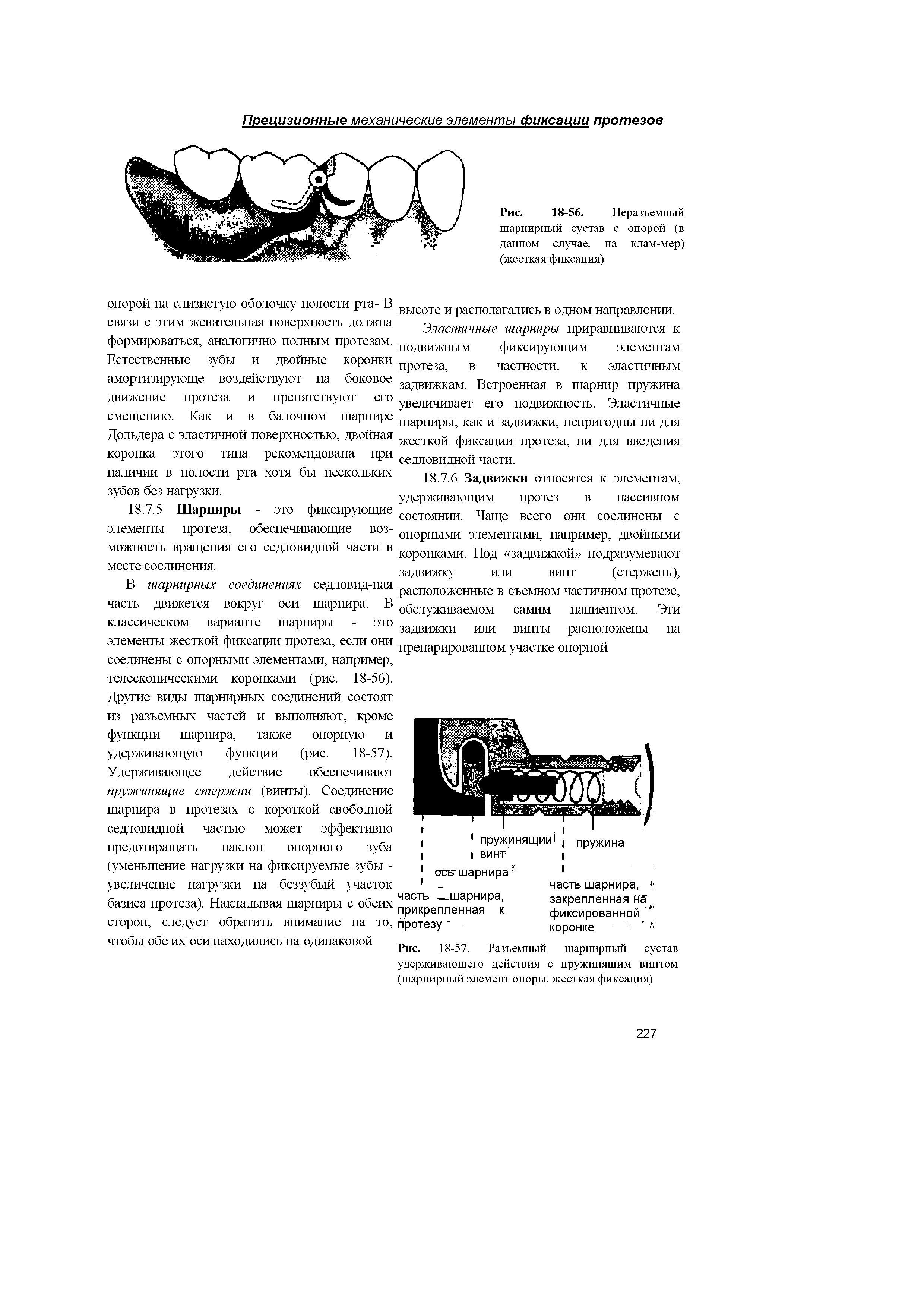 Рис. 18-56. Неразъемный шарнирный сустав с опорой (в данном случае, на клам-мер) (жесткая фиксация)...