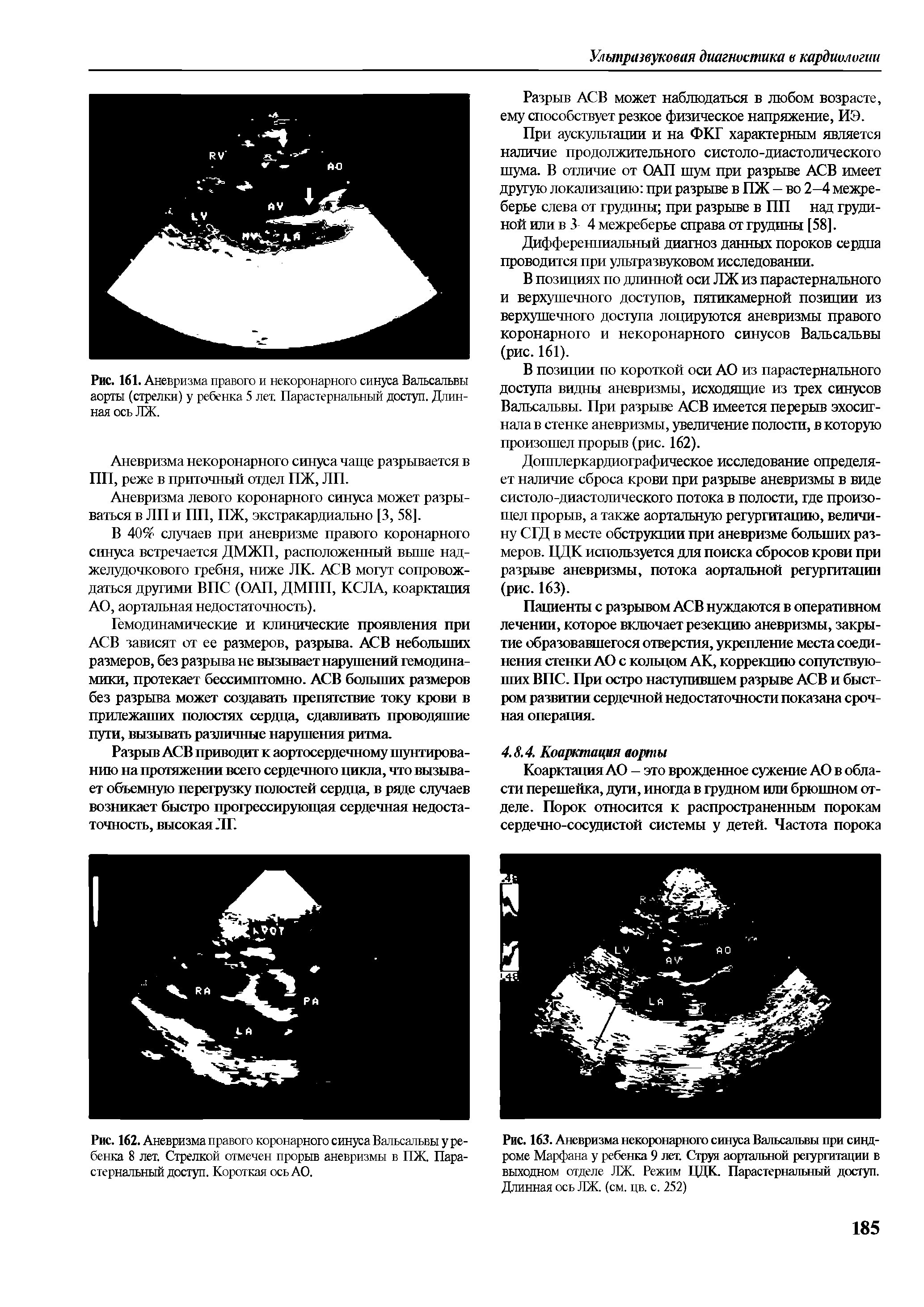 Рис. 163. Аневризма некоронарного синуса Вальсальвы при синдроме Марфана у ребенка 9 лет. Струя аортальной регургитации в выходном отделе ЛЖ. Режим ЦДК. Парастернальный доступ. Длинная ось ЛЖ. (см. цв. с. 252)...