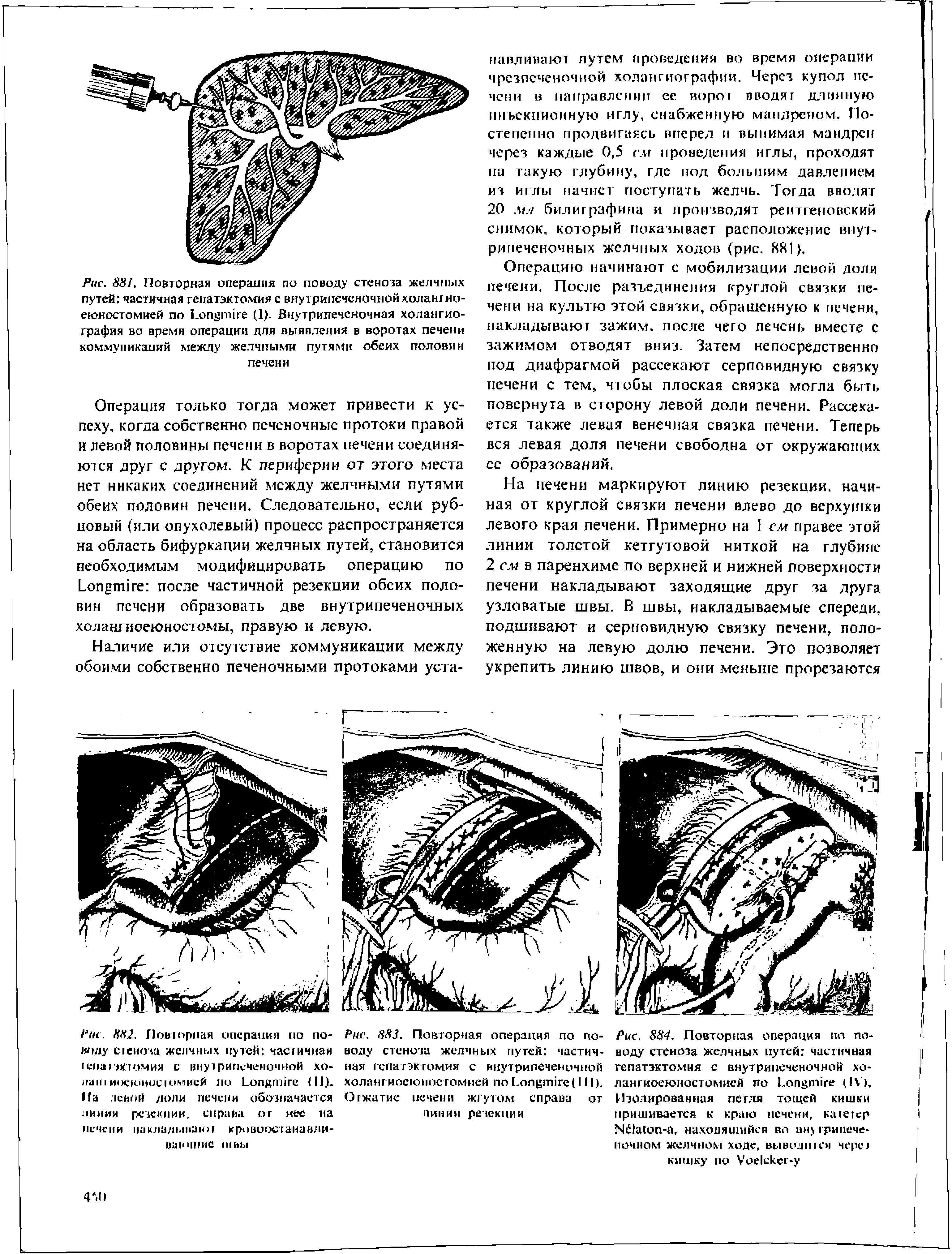 Рис. 883. Повторная операция по поводу стеноза желчных путей частичная гепатэктомия с внутрипеченочной холангиоеюностомией по Ьопвгтге(111). Отжатие печени жгутом справа от линии резекции...