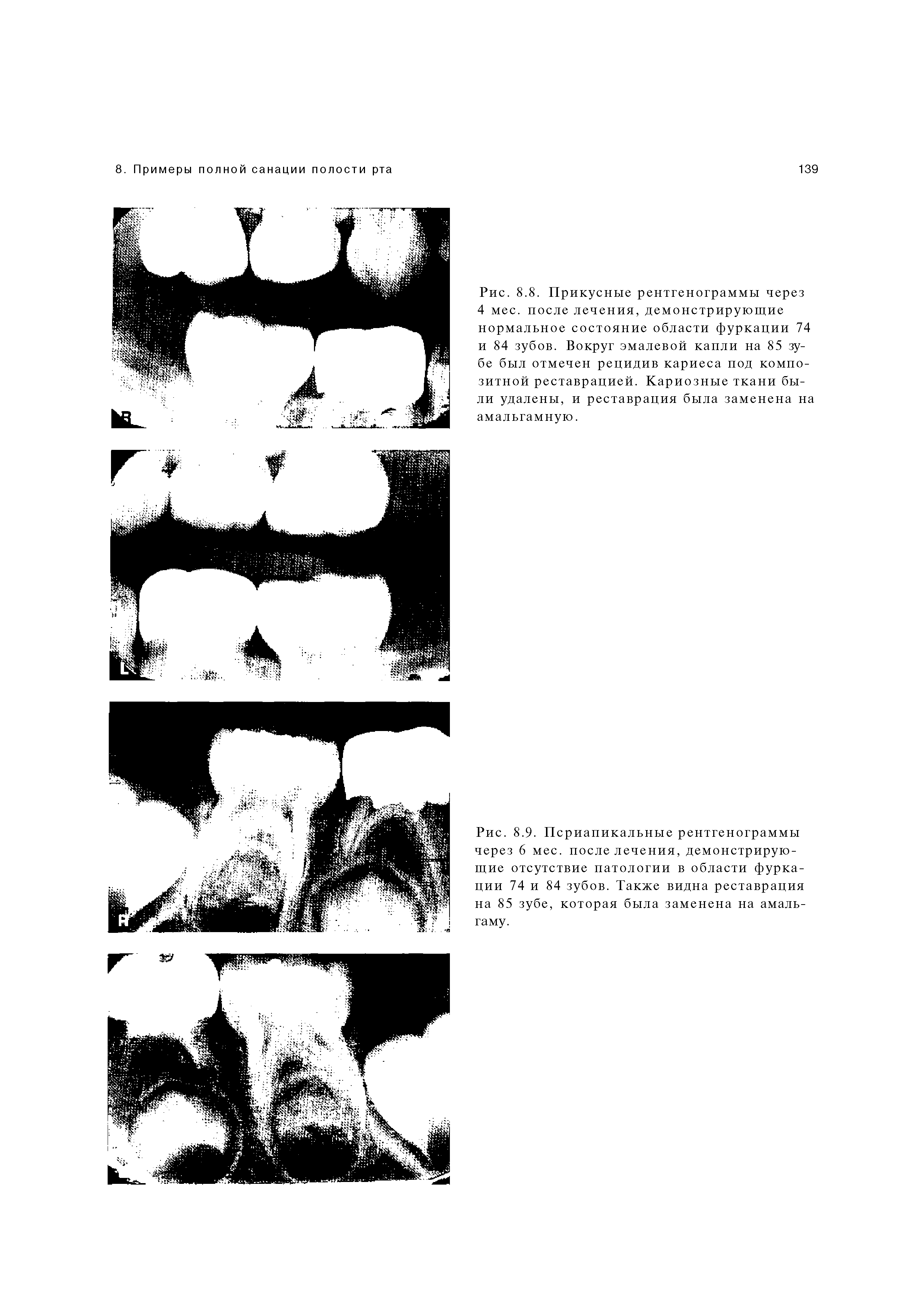 Рис. 8.8. Прикусные рентгенограммы через 4 мес. после лечения, демонстрирующие нормальное состояние области фуркации 74 и 84 зубов. Вокруг эмалевой капли на 85 зубе был отмечен рецидив кариеса под композитной реставрацией. Кариозные ткани были удалены, и реставрация была заменена на амальгамную.