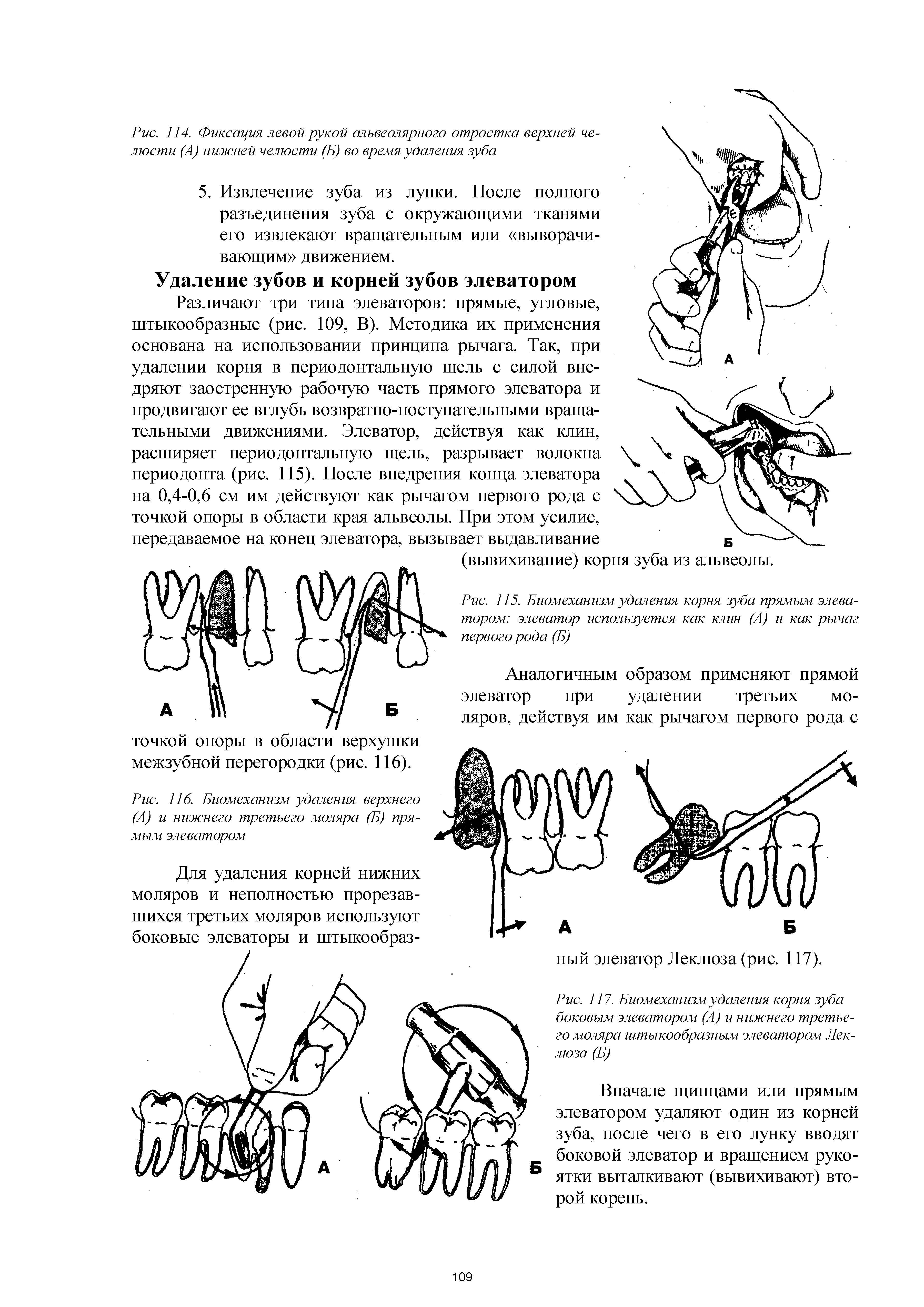 Рис. 117. Биомеханизм удаления корня зуба боковым элеватором (А) и нижнего третьего моляра штыкообразным элеватором Леклюза (Б)...