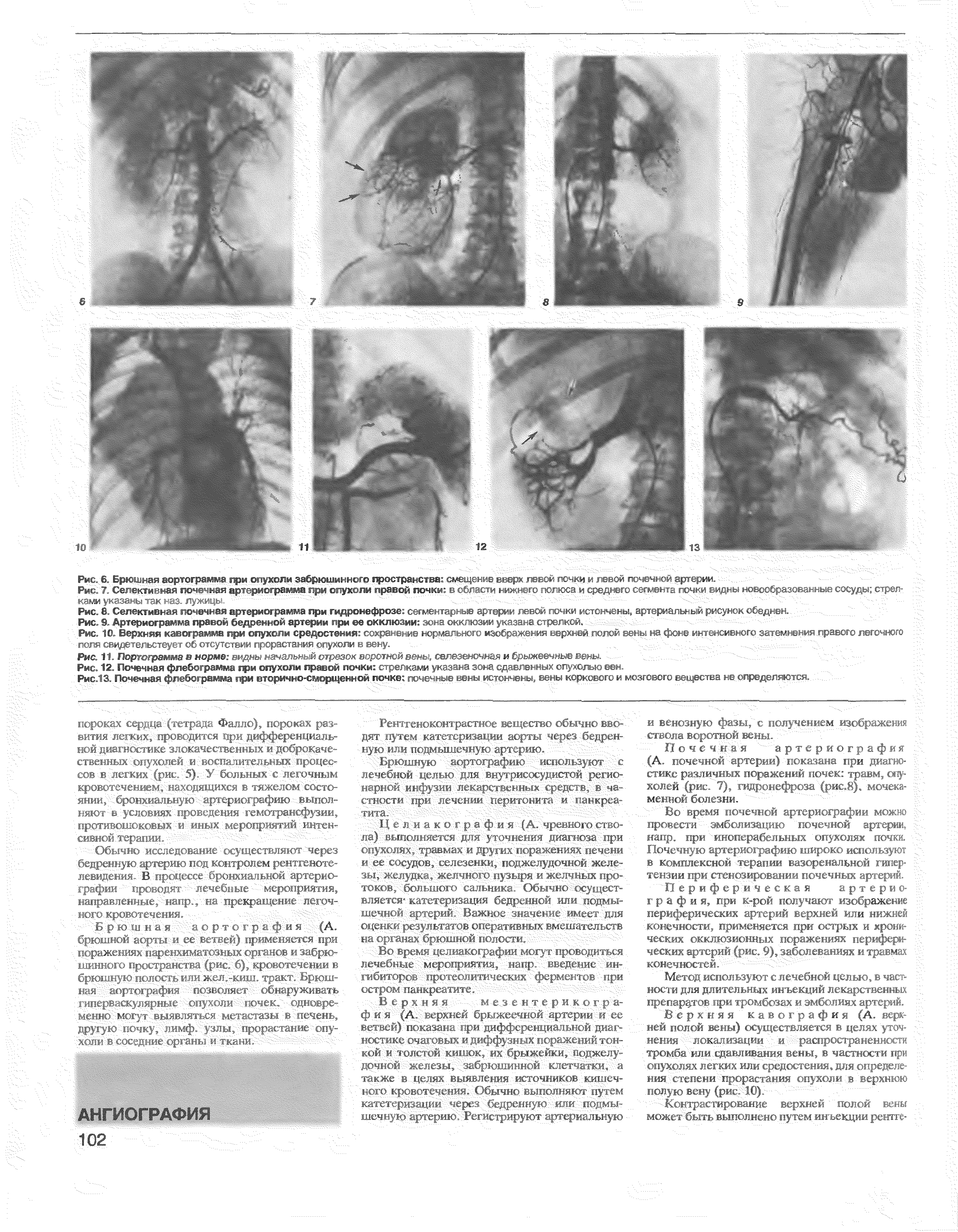 Рис. 8. Селективная почечная артериограмма при гидронефрозе сегментарные артерии левой почки истончены, артериальный рисунок обеднен. у...