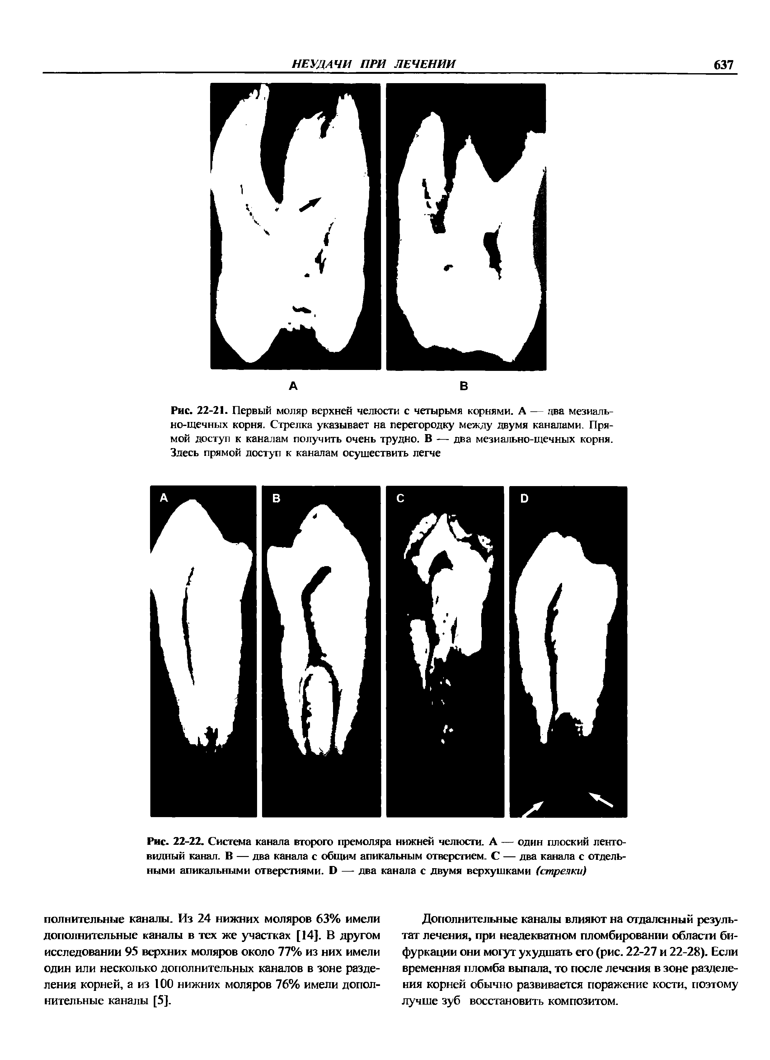 Рис. 22-22. Система канала второго премоляра нижней челюсти. А — один плоский лентовидный канал. В — два канала с общим апикальным отверстием. С — два канала с отдельными апикальными отверстиями. Б — два канала с двумя верхушками (стрелки)...