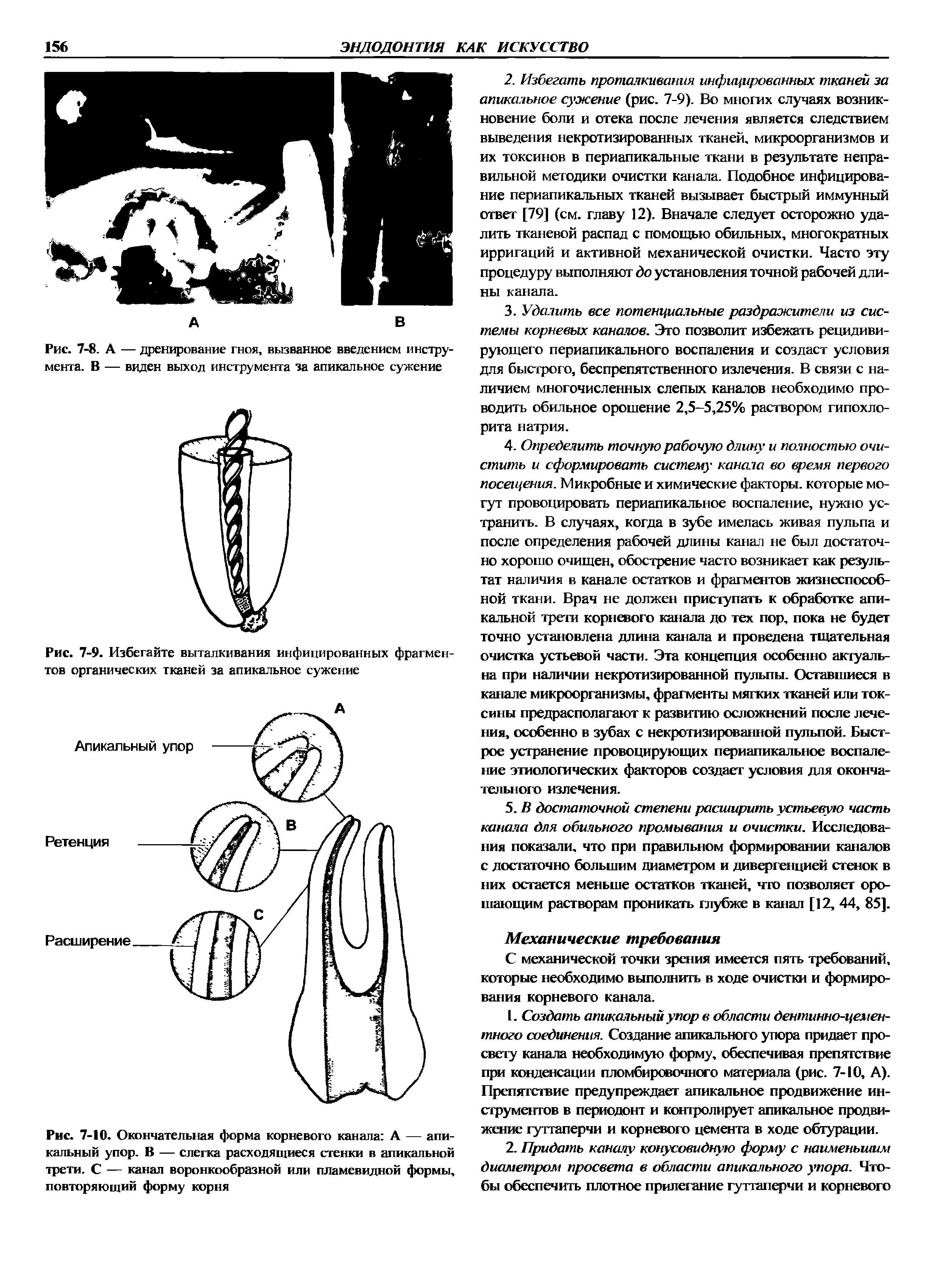 Рис. 7-10. Окончательная форма корневого канала А — апикальный упор. В — слегка расходящиеся стенки в апикальной трети. С — канал воронкообразной или пламевидной формы, повторяющий форму корня...