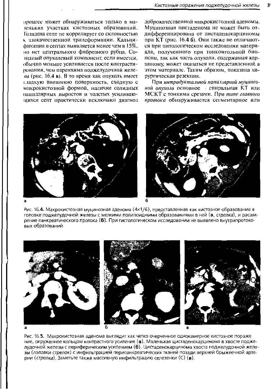 Рис. 16.4. Макрокистозная муцинозная аденома (4 1/6), представленная как кистозное образование в головке поджелудочной железы с мелкими полипоидными образованиями в ней (а, стрелка, и расширение панкреатического протока (6). При гистологическом исследовании не выявлено внутрипротоковых образований...