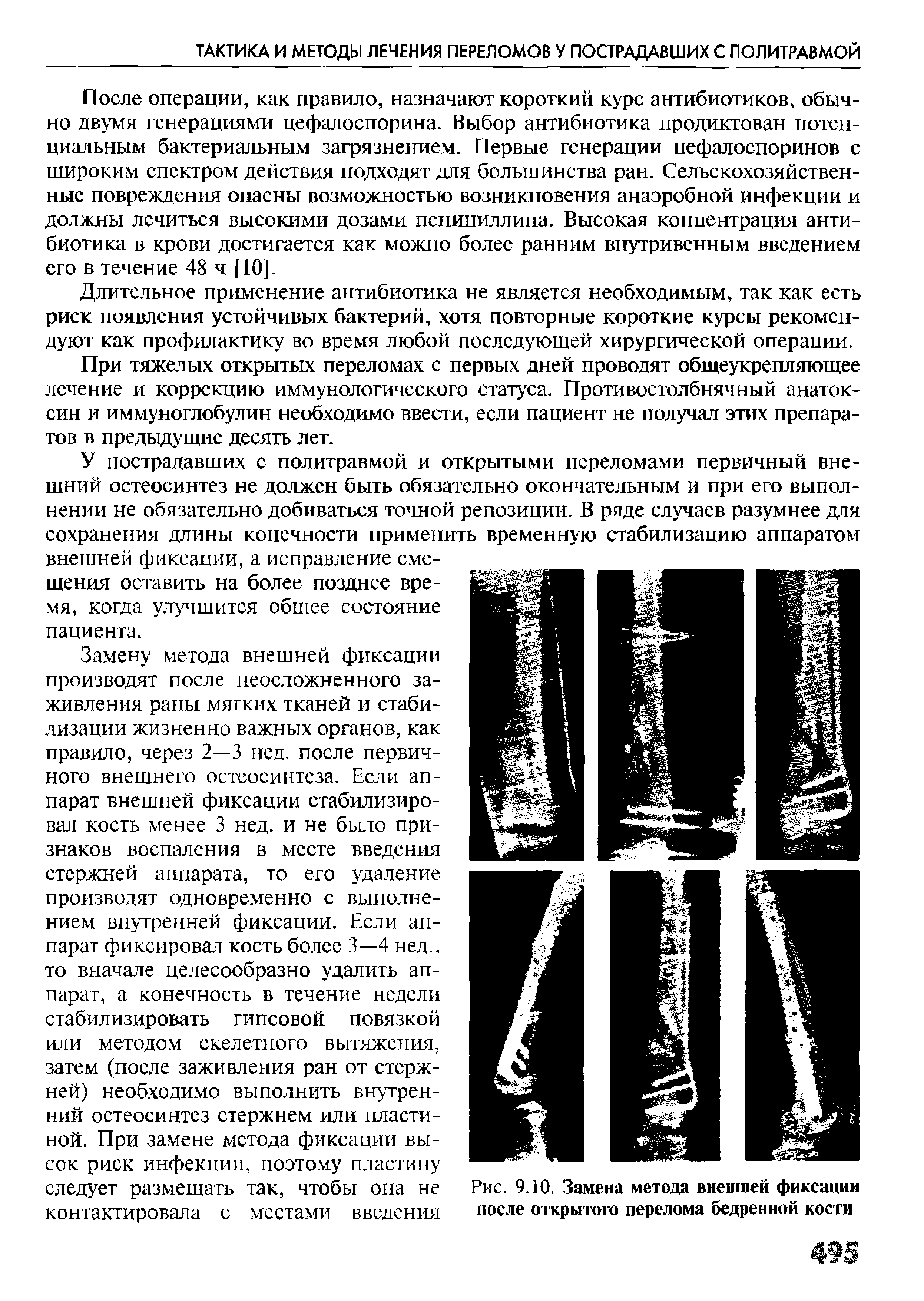 Рис. 9.10, Замена метода внешней фиксации после открытого перелома бедренной кости...