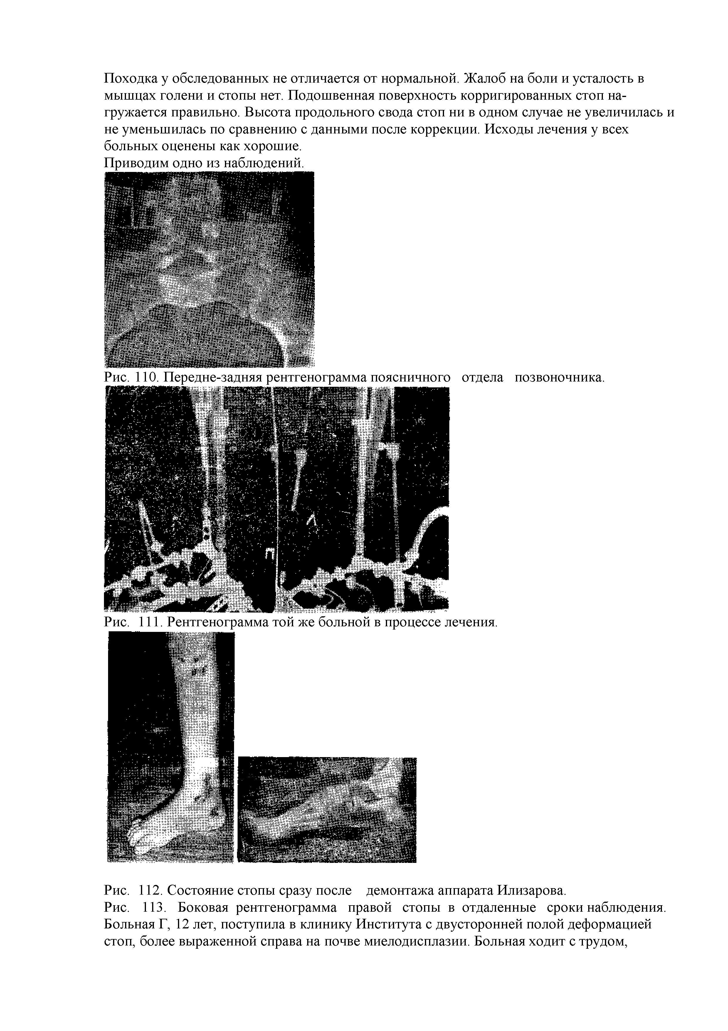 Рис. ИЗ. Боковая рентгенограмма правой стопы в отдаленные сроки наблюдения. Больная Г, 12 лет, поступила в клинику Института с двусторонней полой деформацией стоп, более выраженной справа на почве миелодисплазии. Больная ходит с трудом,...