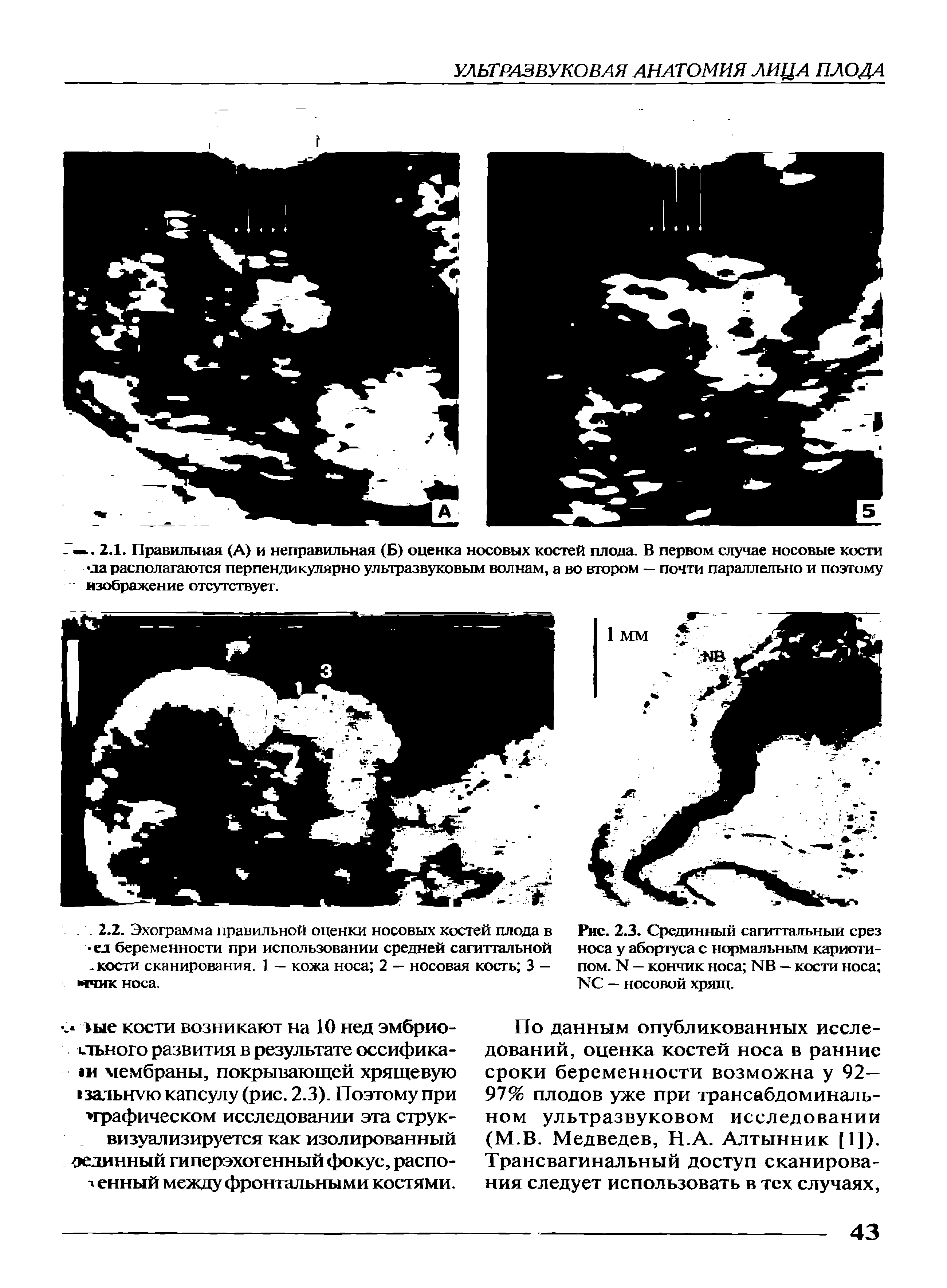 Рис. 2.3. Срединный сагиттальный срез носа у абортуса с нормальным кариотипом. N — кончик носа N6 — кости носа КС — носовой хрящ.