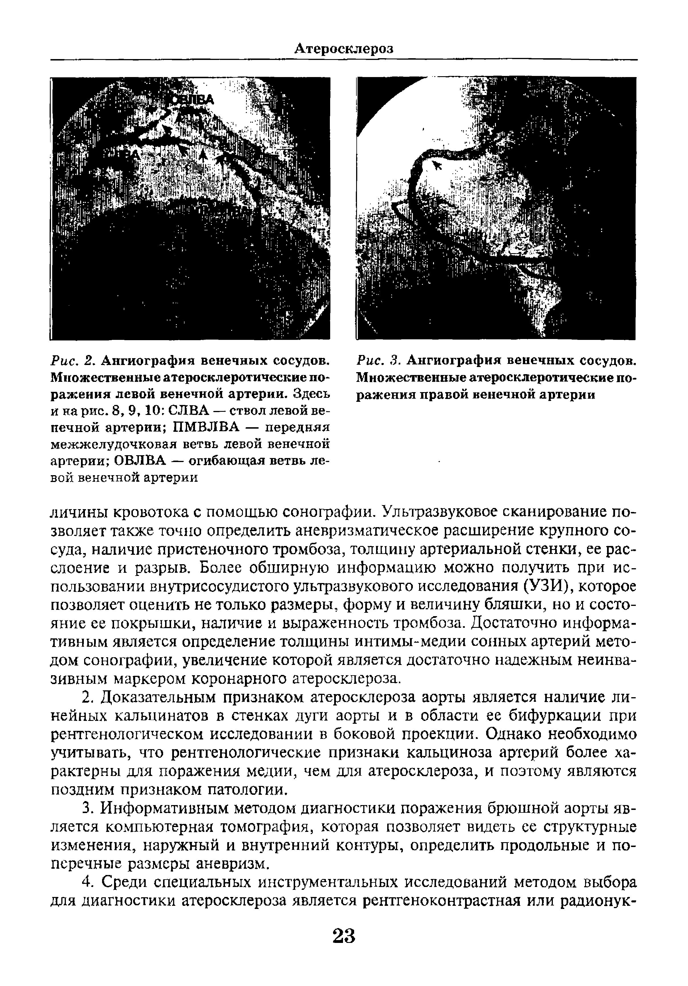 Рис. 2. Ангиография венечных сосудов. Множественные атеросклеротические поражения левой венечной артерии. Здесь и на рис. 8, 9,10 СЛВА — ствол левой ве-печной артерии ПМВЛВА — передняя межжелудочковая ветвь левой венечной артерии ОВЛВА — огибающая ветвь левой венечной артерии...