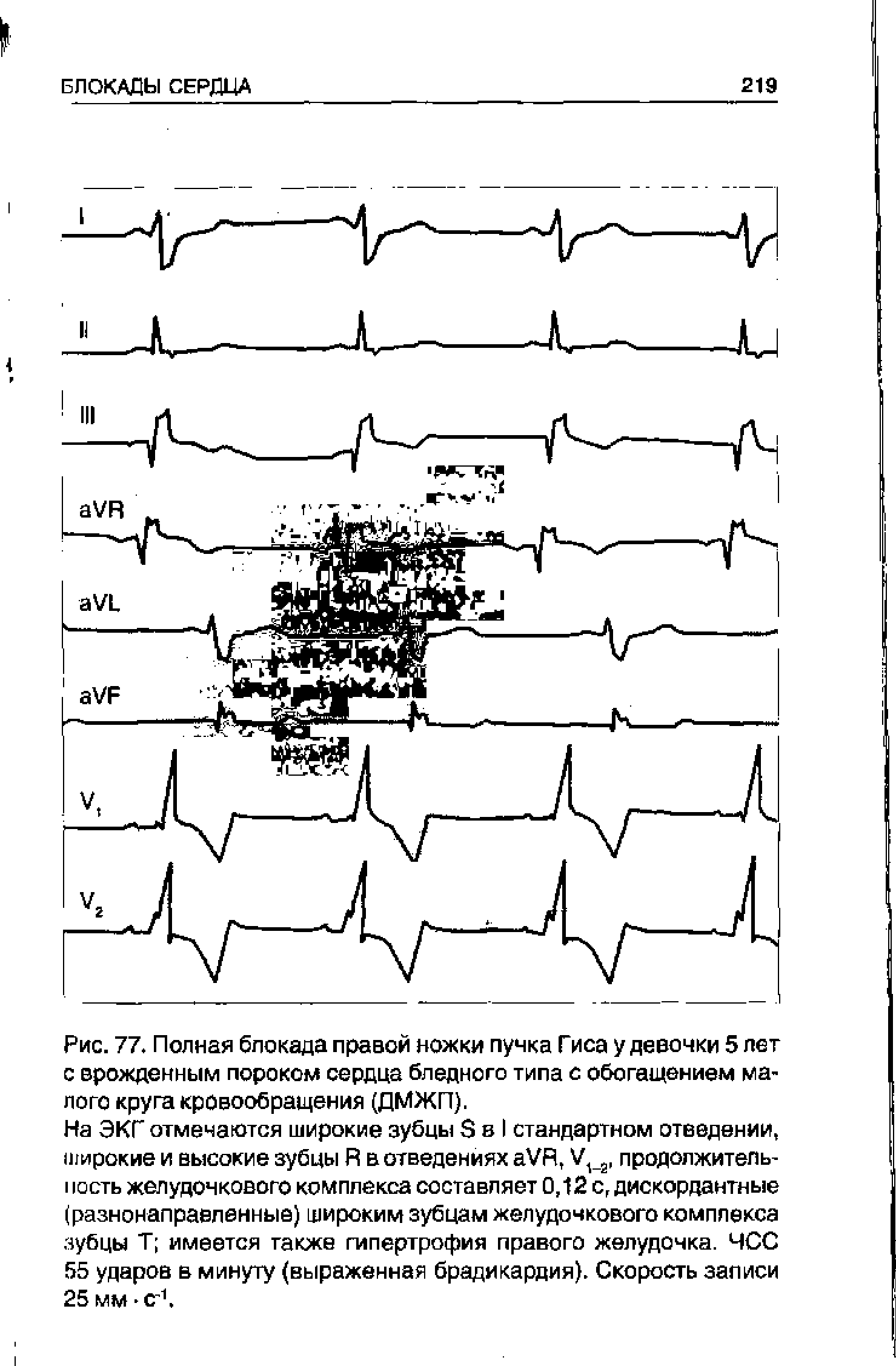 Рис. 77. Полная блокада правой ножки пучка Гиса у девочки 5 лет с врожденным пороком сердца бледного типа с обогащением малого круга кровообращения (ДМЖП).