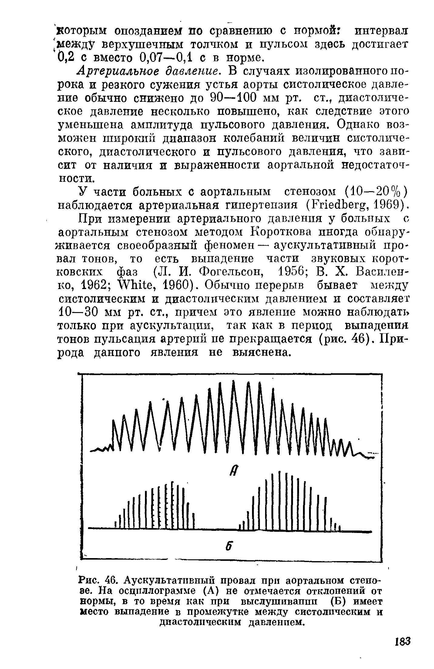 Рис. 46. Аускультативный провал при аортальном стено-эе. На осциллограмме (А) не отмечается отклонений от нормы, в то время как при выслушиваппп (Б) имеет место выпадение в промежутке между систолическим и диастолическим давлением.