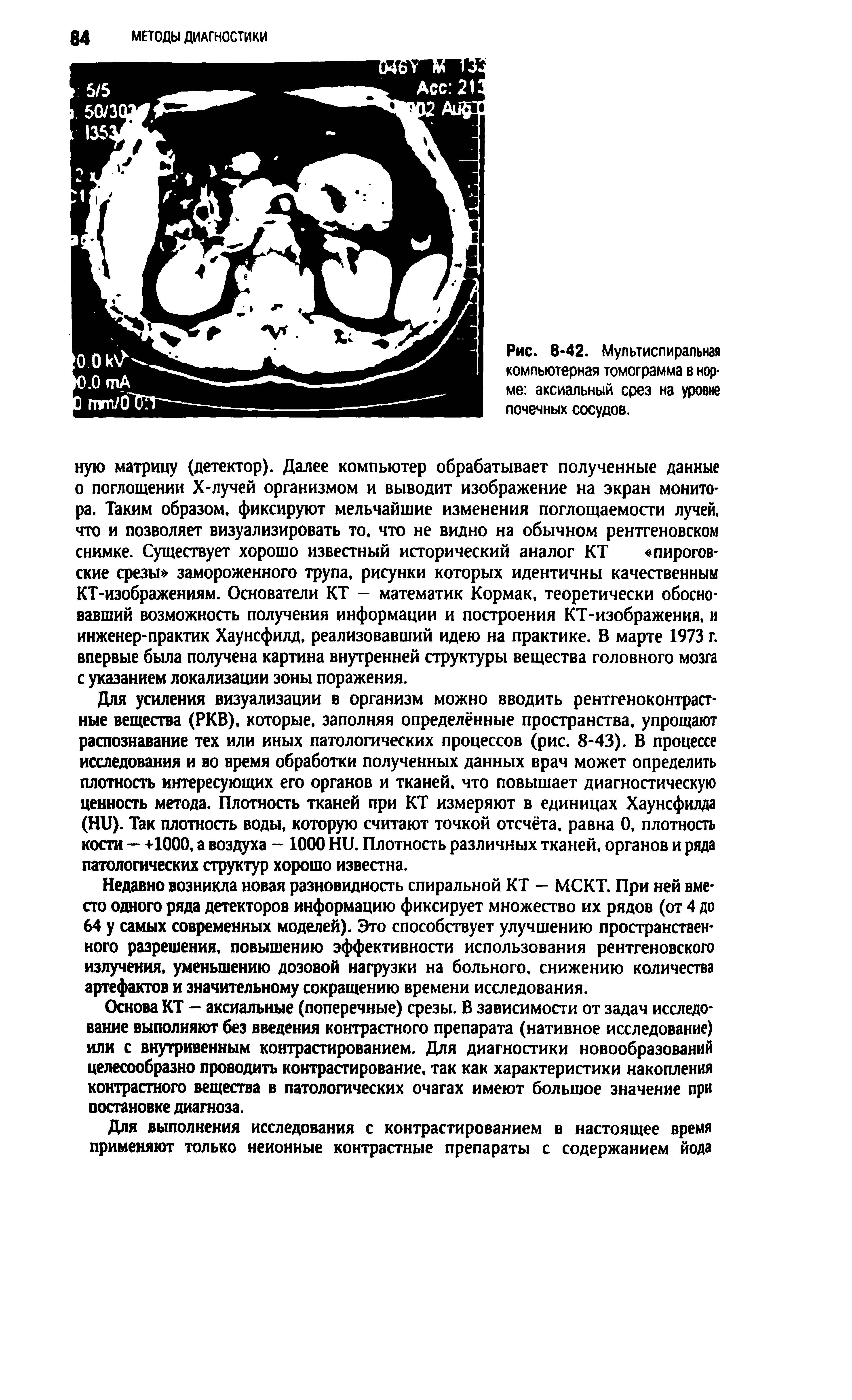 Рис. 8-42. Мультислиральная компьютерная томограмма в норме аксиальный срез на уровне почечных сосудов.