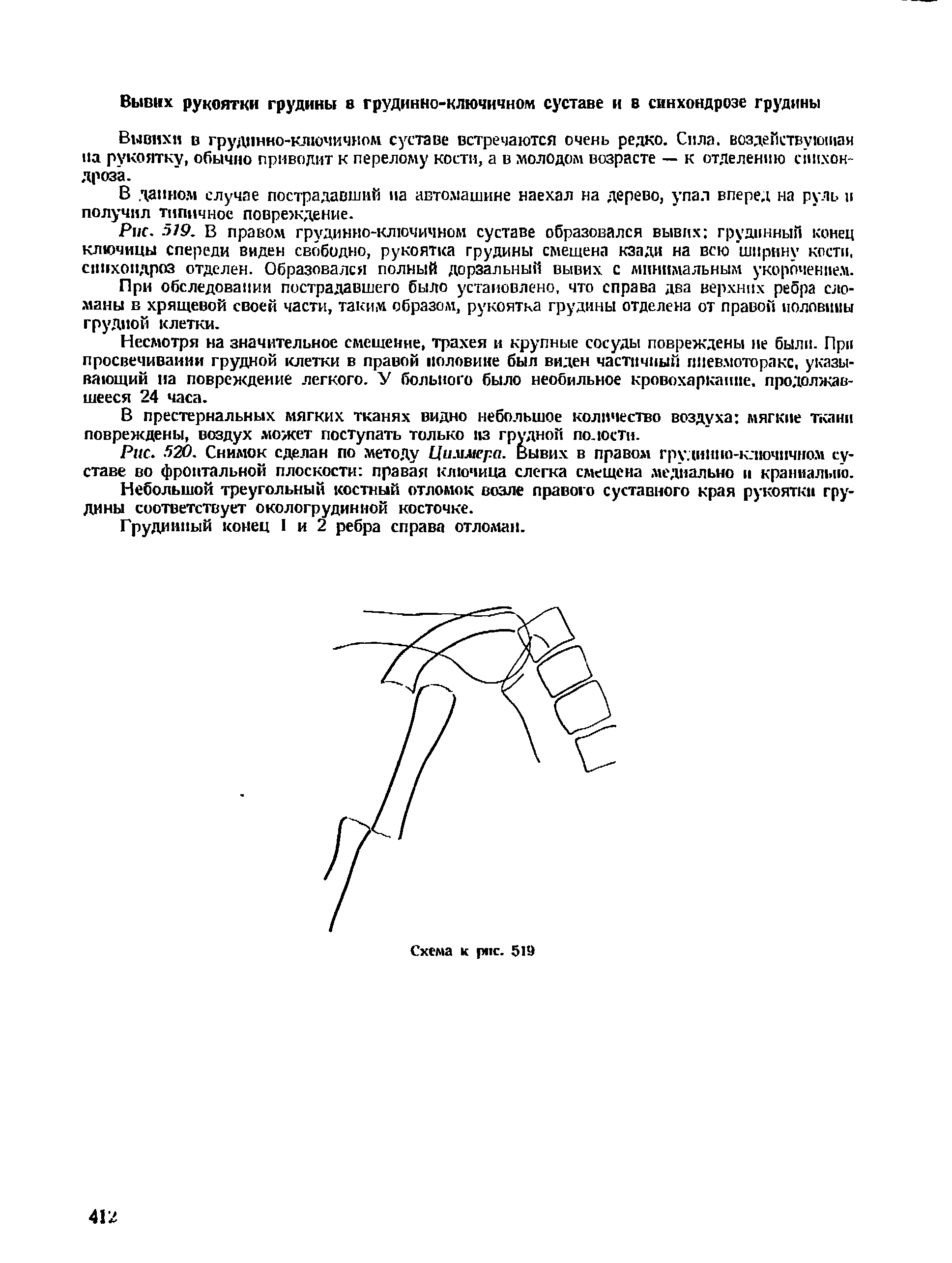 Рис. 519. В правом грудинно-ключичном суставе образовался вывих грудинный конец ключицы Спереди виден свободно, рукоятка грудины смещена кзади на всю ширину кости, синхондроз отделен. Образовался полный дорзальный вывих с минимальным укорочением.