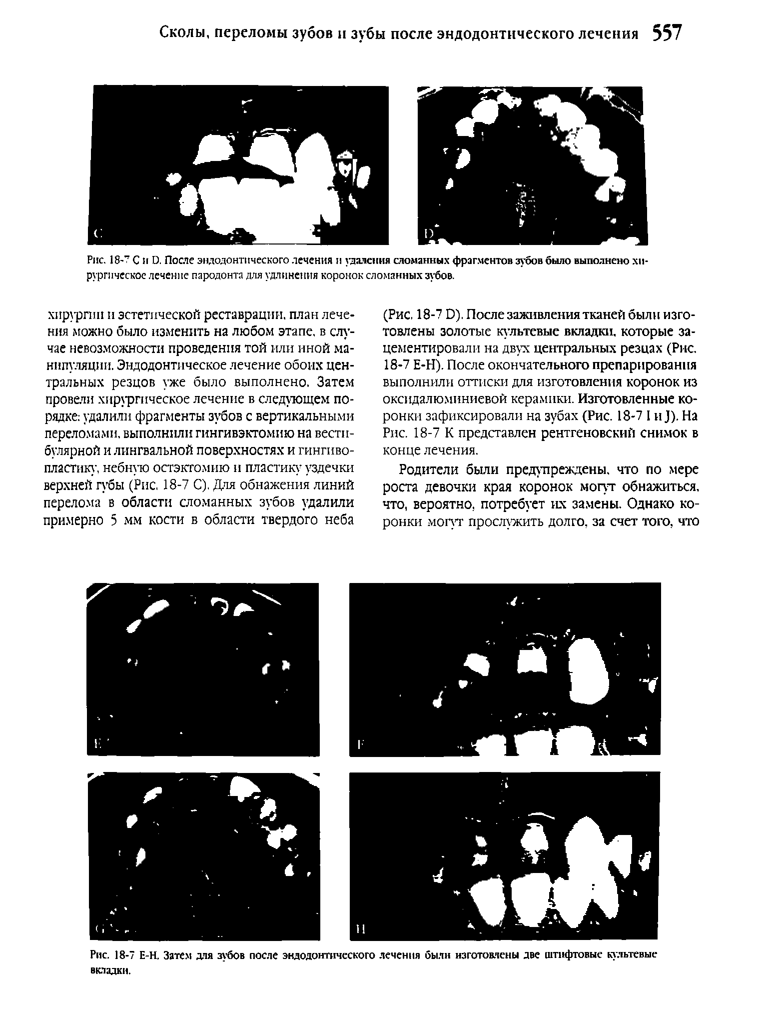 Рис. 18-7 С и . После эндодонтического лечения и удаления сломанных фрагментов зубов было выполнено хирургическое лечение пародонта для удлинения коронок сломанных зубов.