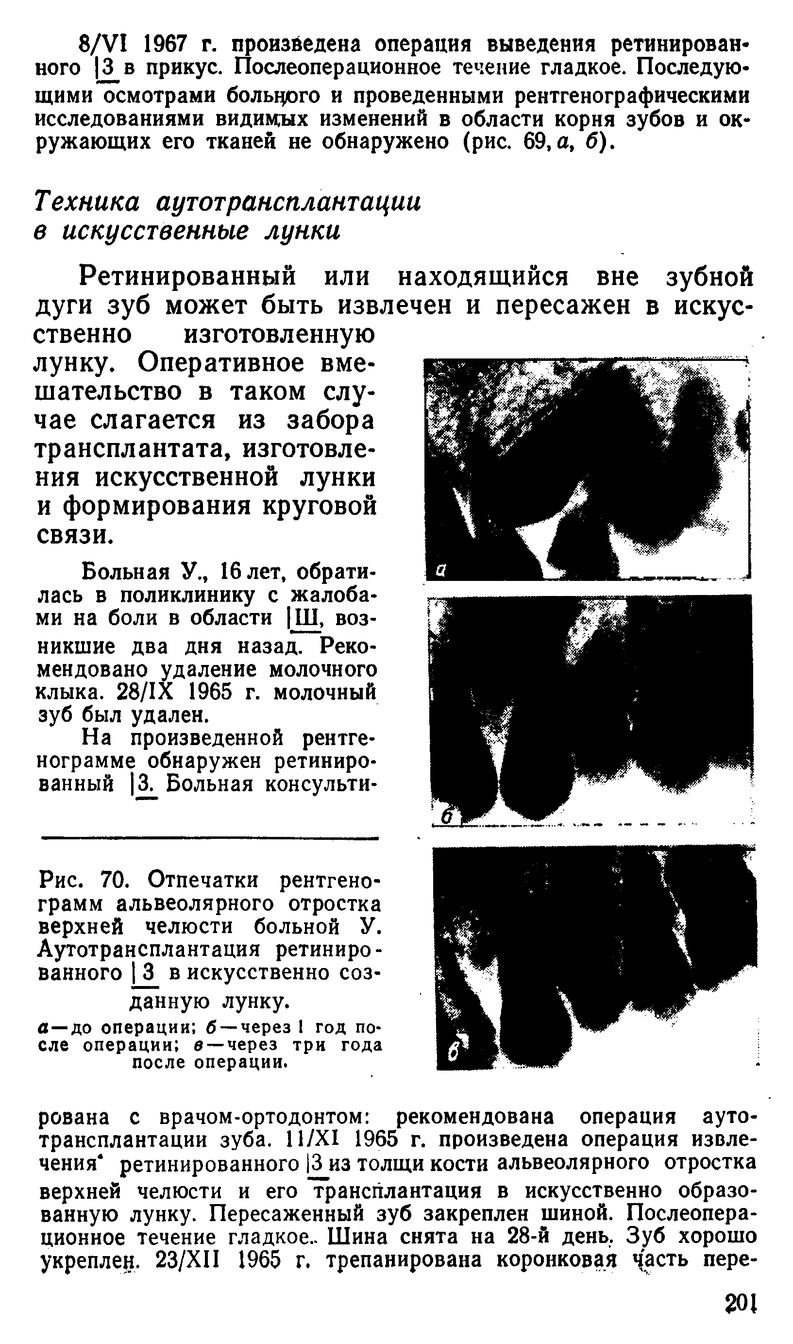 Рис. 70. Отпечатки рентгенограмм альвеолярного отростка верхней челюсти больной У. Аутотрансплантация ретинированного 3 в искусственно созданную лунку.