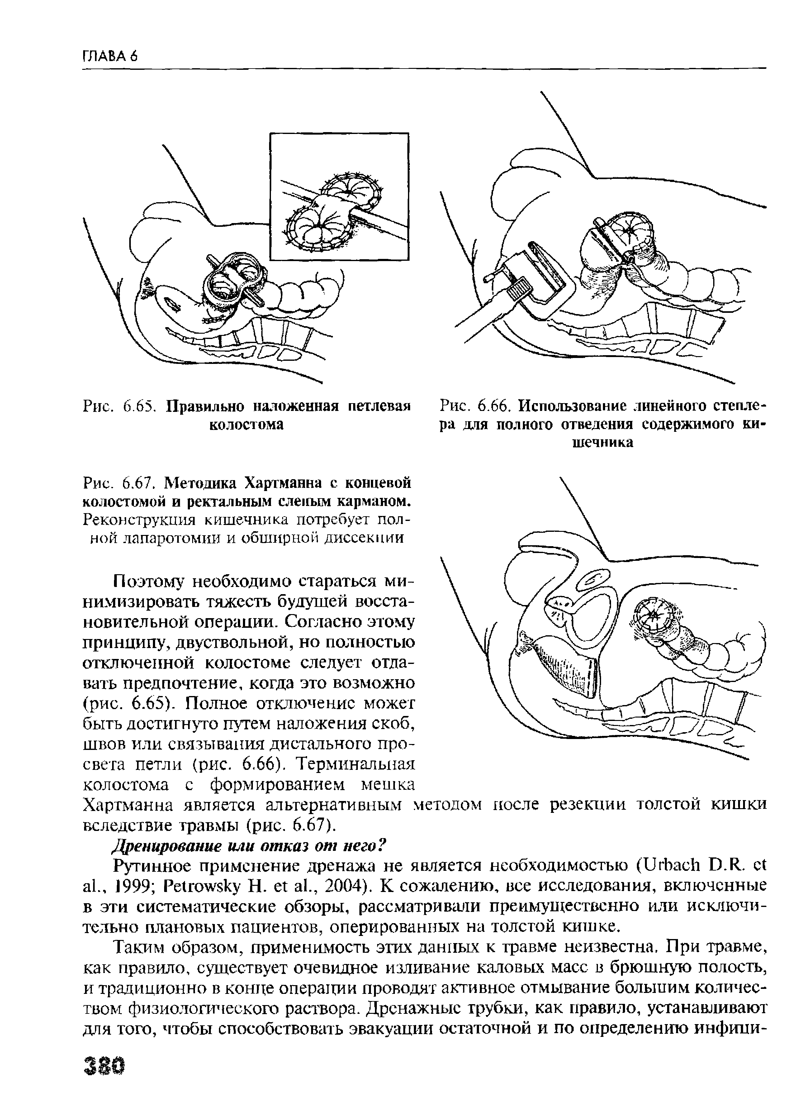 Рис. 6.67. Методика Хартманна с концевой колостомой и ректальным слепым карманом. Реконструкция кишечника потребует полной лапаротомии и обширной диссекции...