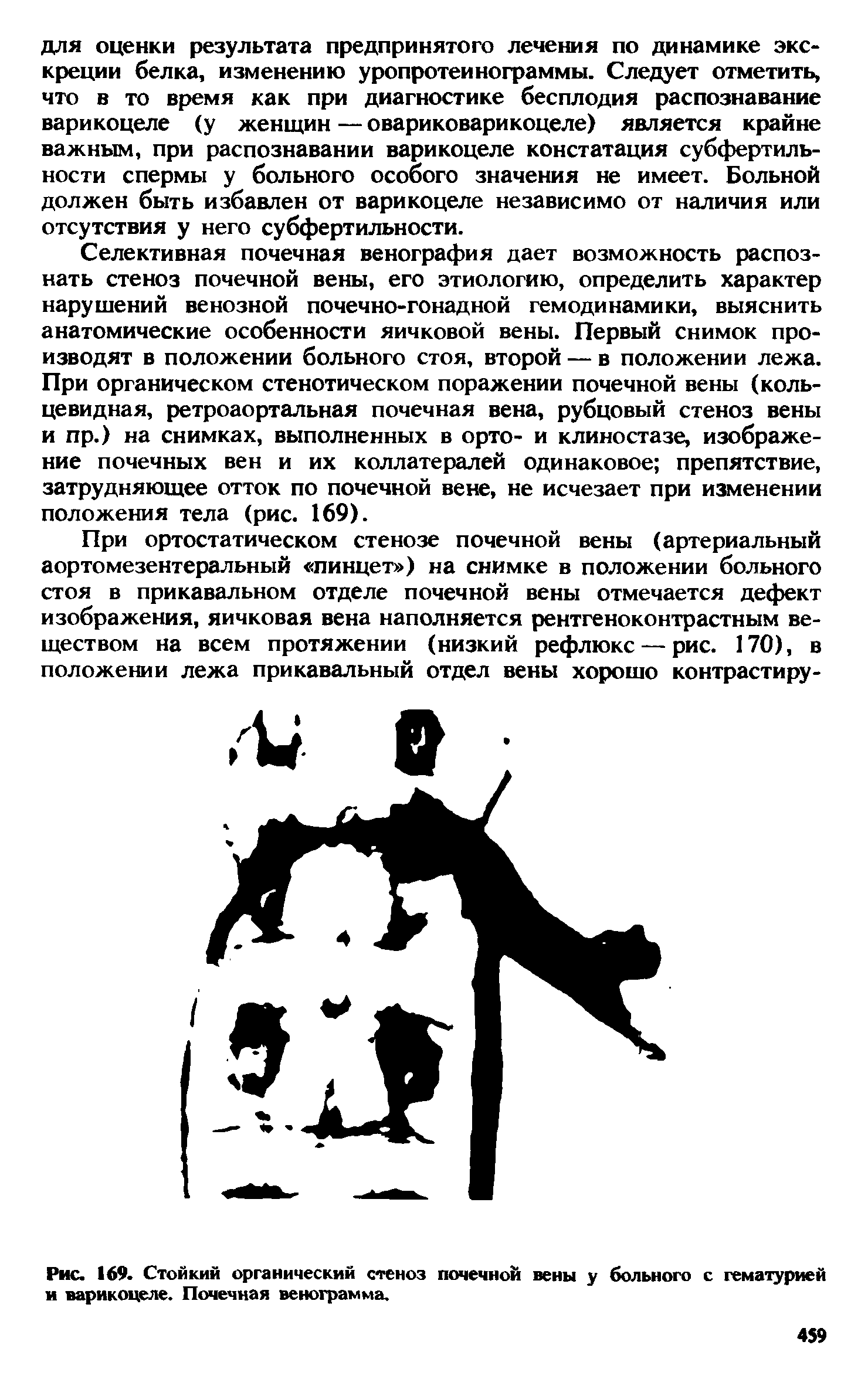 Рис. 169. Стойкий органический стеноз почечной вены у больного с гематурией и варикоцеле. Почечная венограмма.