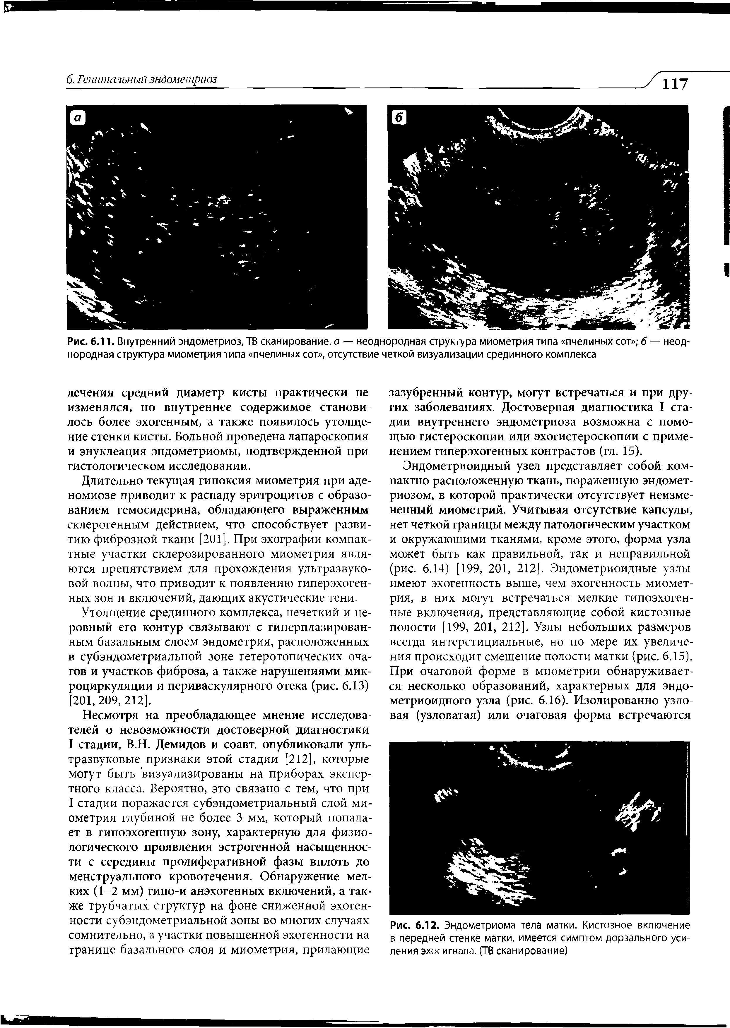 Рис. 6.12. Эндометриома тела матки. Кистозное включение в передней стенке матки, имеется симптом дорзального усиления эхосигнала. (ТВ сканирование)...