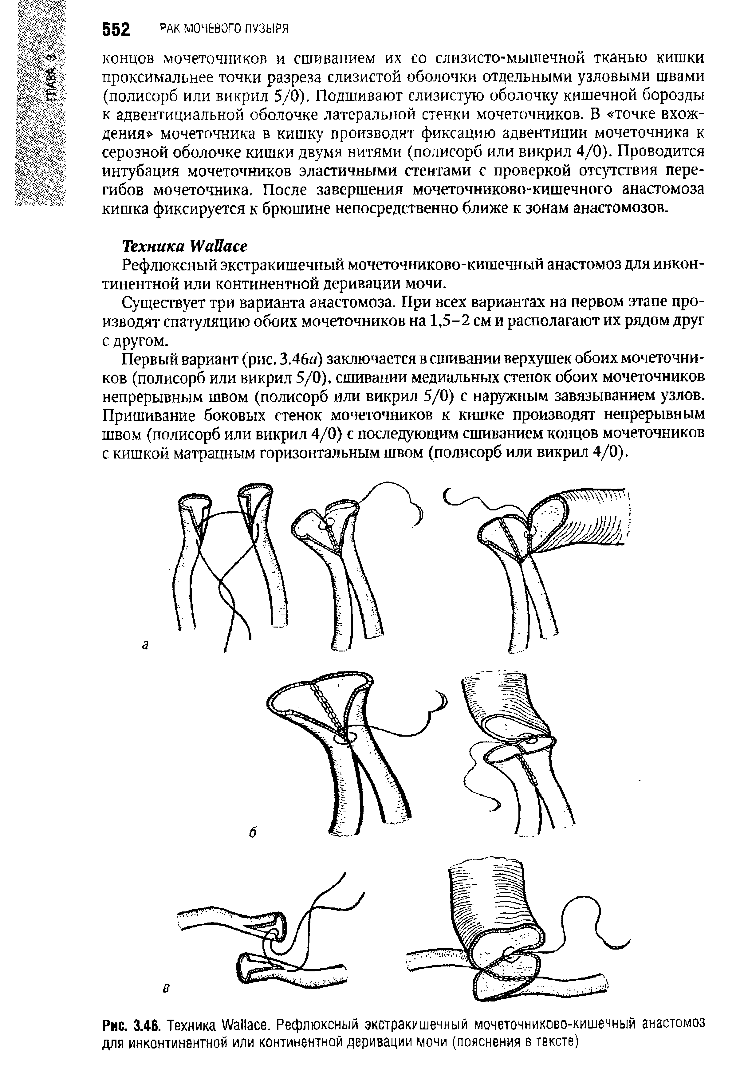 Рис. 3.46. Техника W . Рефлюксный экстракишечный мочеточниково-кишечный анастомоз для инконтинентной или континентной деривации мочи (пояснения в тексте)...