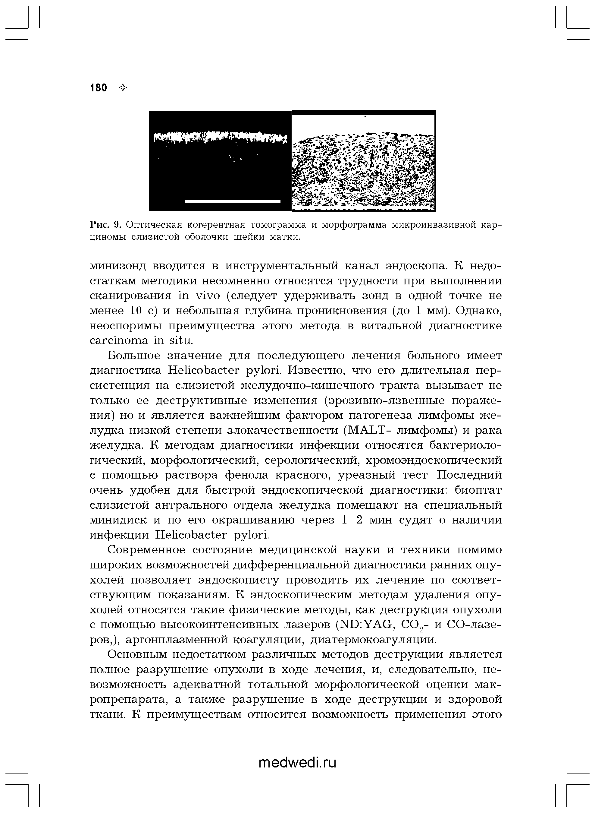 Рис. 9. Оптическая когерентная томограмма и морфограмма микроинвазивной карциномы слизистой оболочки шейки матки.