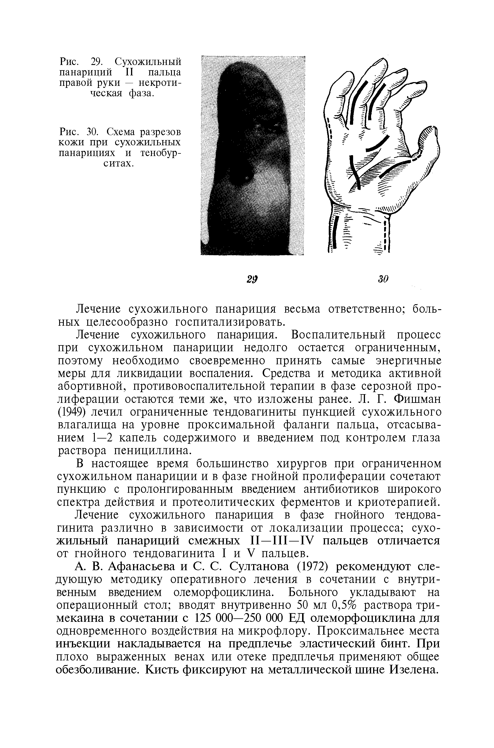 Рис. 29. Сухожильный панариций II пальца правой руки — некротическая фаза.