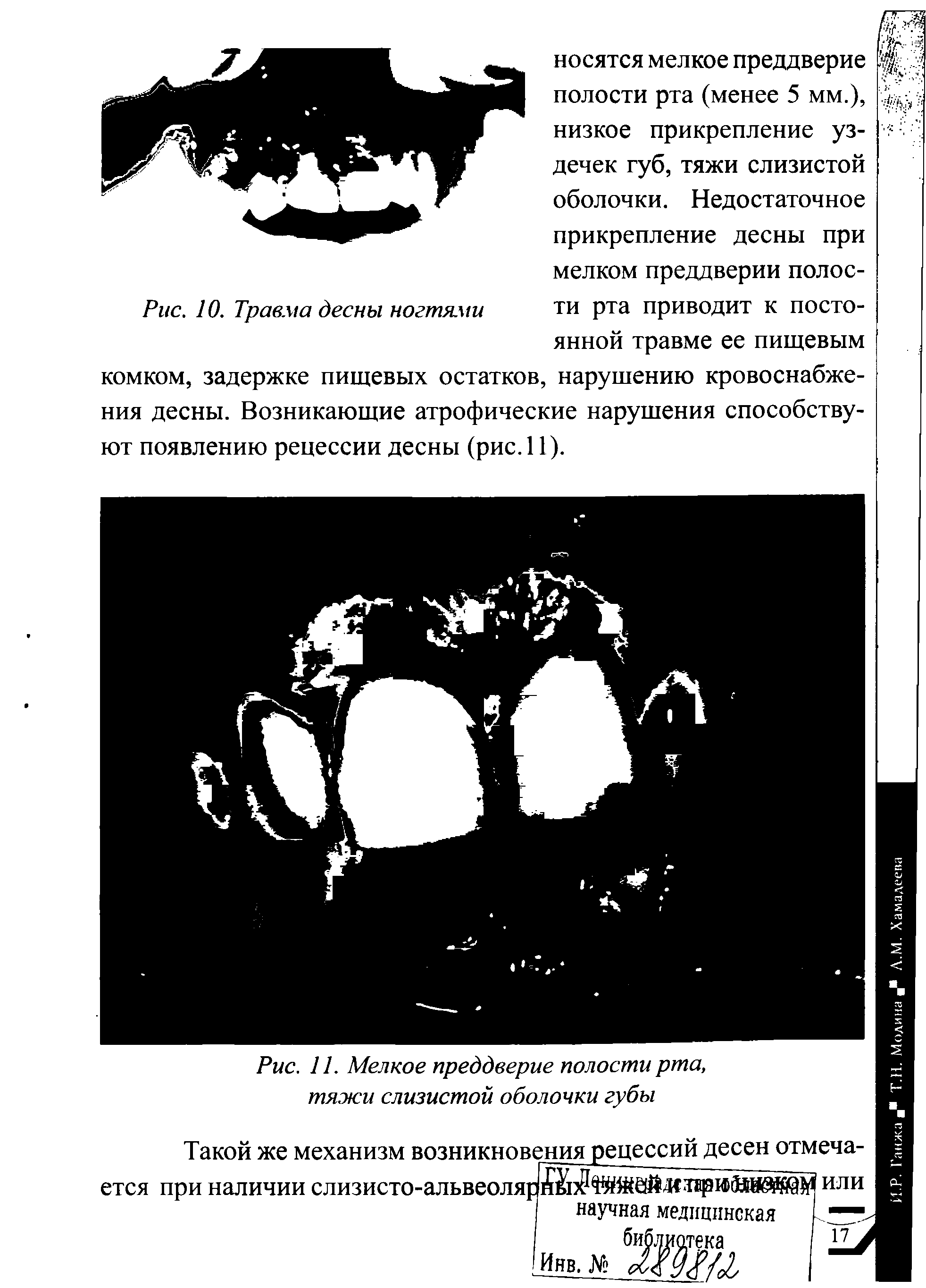 Рис. 10. Травма десны ногтями ти рта приводит к постоянной травме ее пищевым комком, задержке пищевых остатков, нарушению кровоснабжения десны. Возникающие атрофические нарушения способствуют появлению рецессии десны (рис.11).