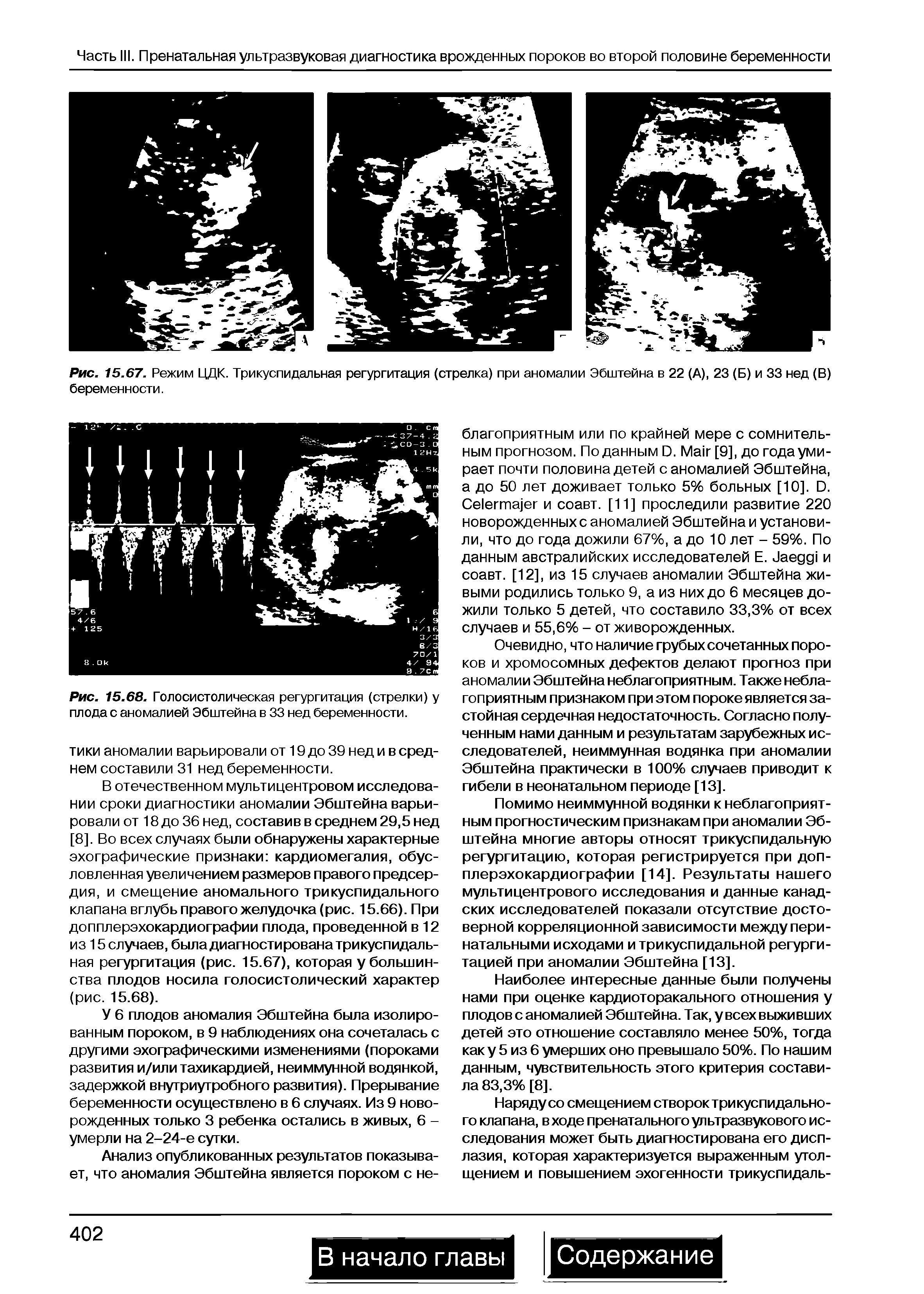 Рис. 15.67. Режим ЦДК. Трикуспидальная регургитация (стрелка) при аномалии Эбштейна в 22 (А), 23 (Б) и 33 нед (В) беременности.