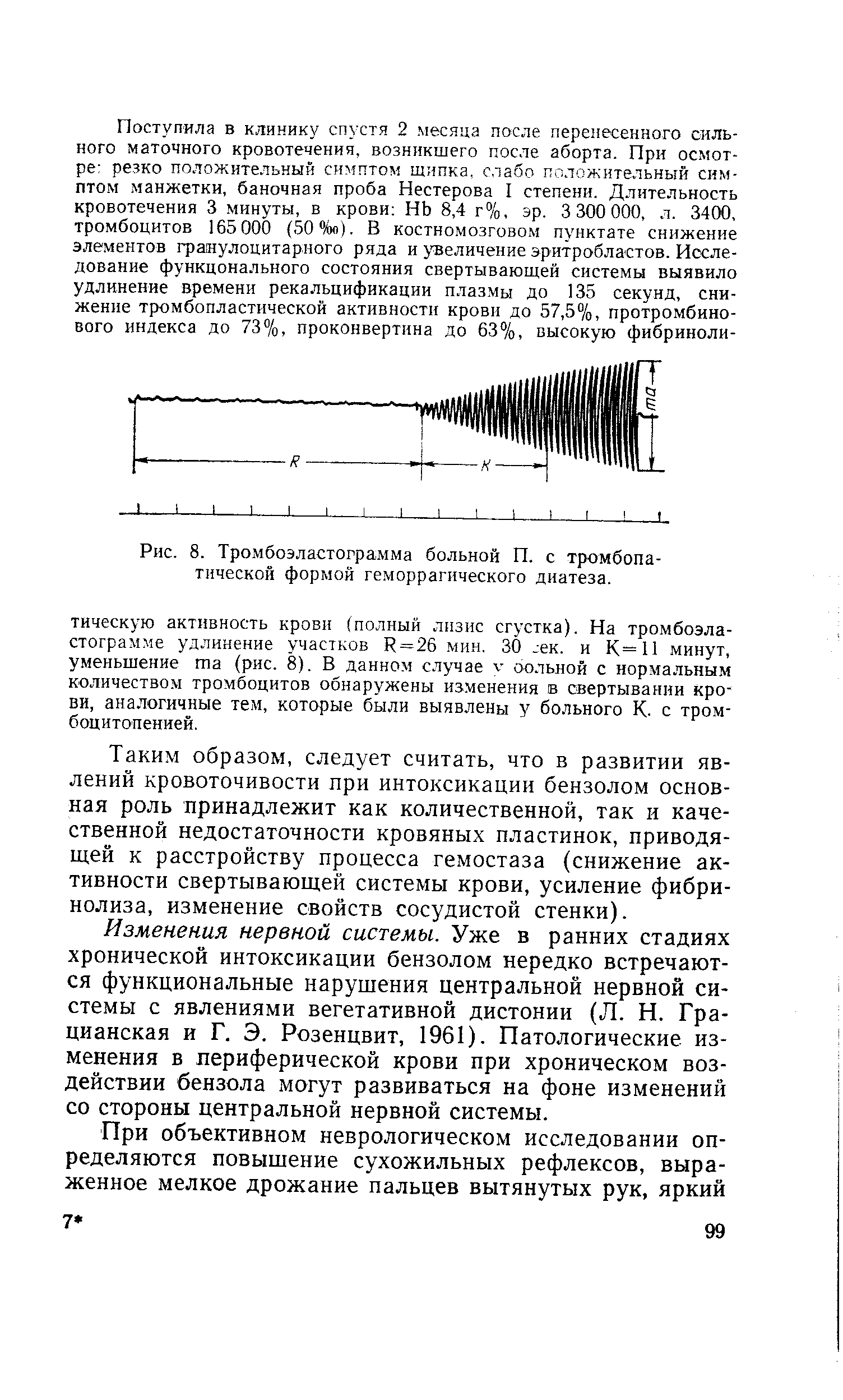 Рис. 8. Тромбоэластограмма больной П. с тромбопатической формой геморрагического диатеза.