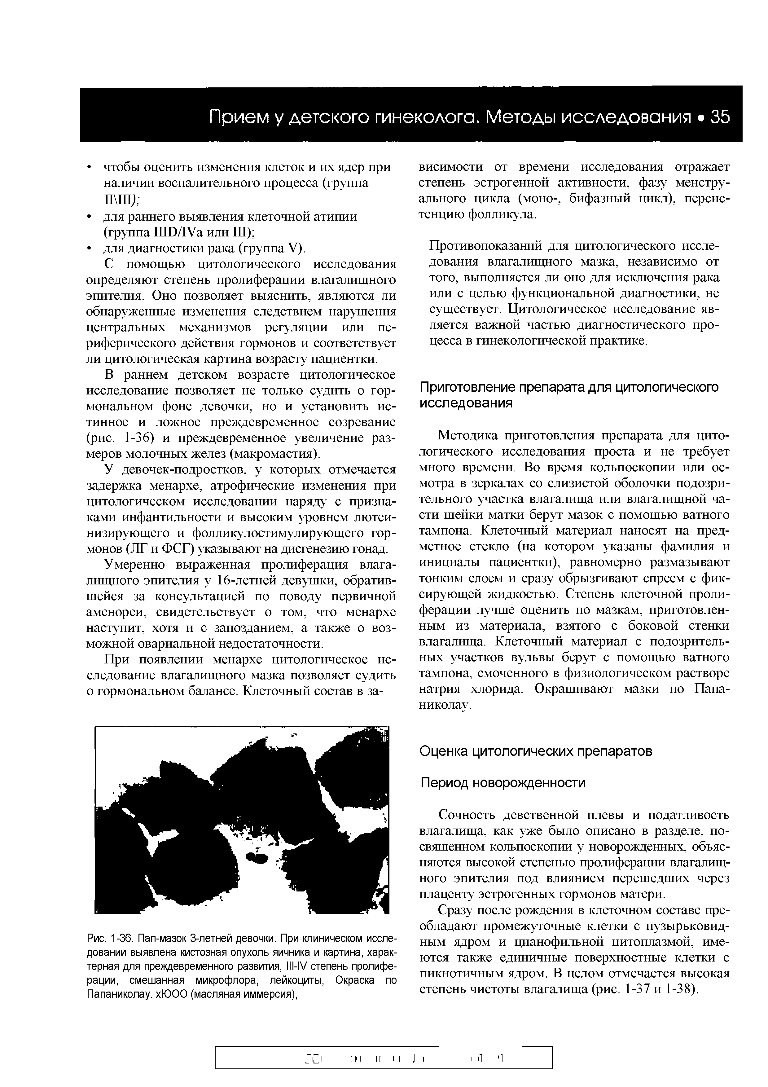 Рис. 1-36. Пап-мазок 3-летней девочки. При клиническом исследовании выявлена кистозная опухоль яичника и картина, характерная для преждевременного развития, Ш-У степень пролиферации, смешанная микрофлора, лейкоциты, Окраска по Папаниколау. хЮОО (масляная иммерсия),...