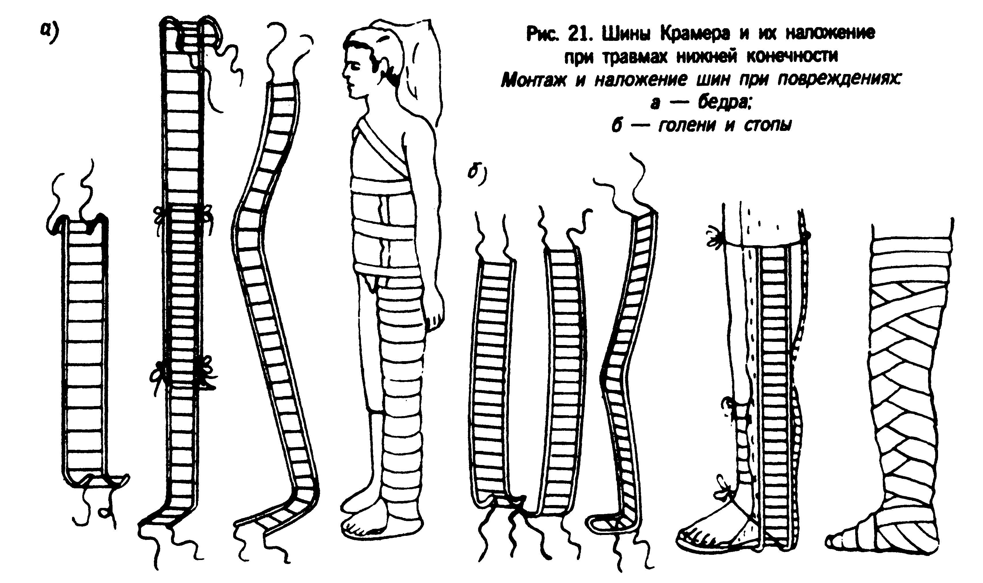 Лестничная шина для иммобилизации. Иммобилизация бедра шиной Крамера. Лестничная шина Крамера бедро. Техника наложения шины Крамера при переломе. Иммобилизация костей голени шиной Крамера.