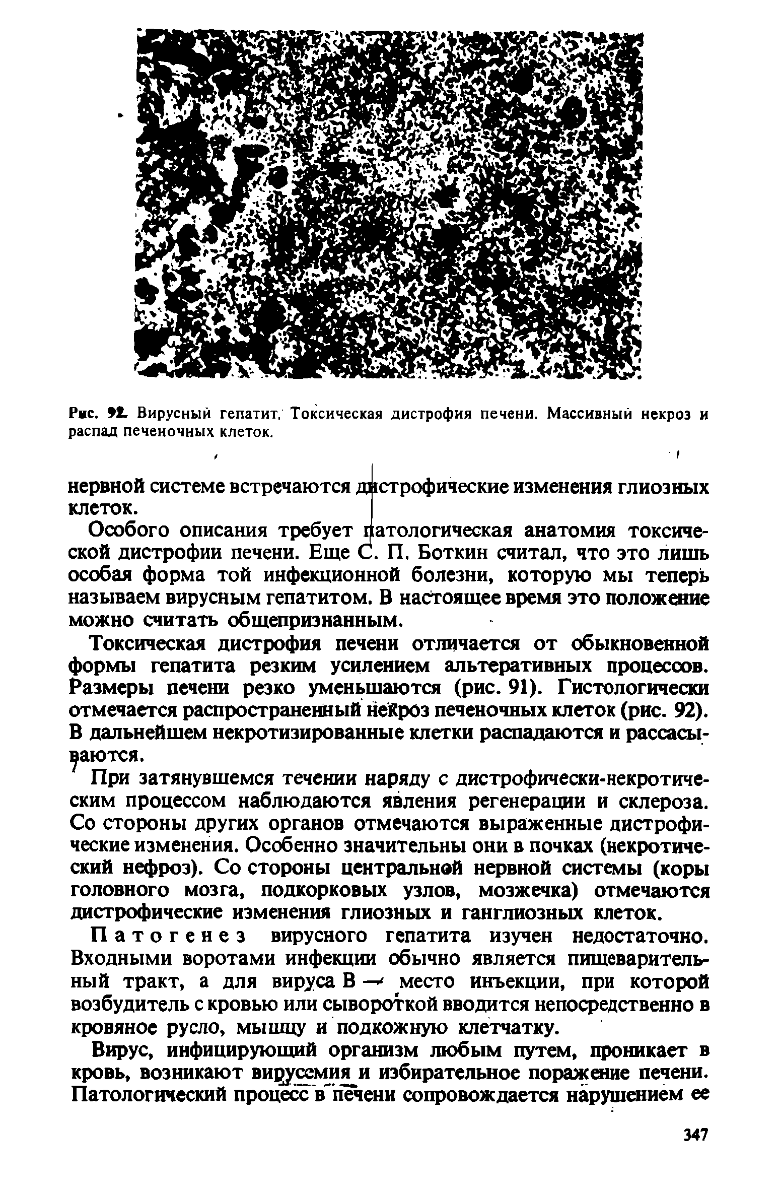 Рис. 2, Вирусный гепатит. Токсическая дистрофия распад печеночных клеток.