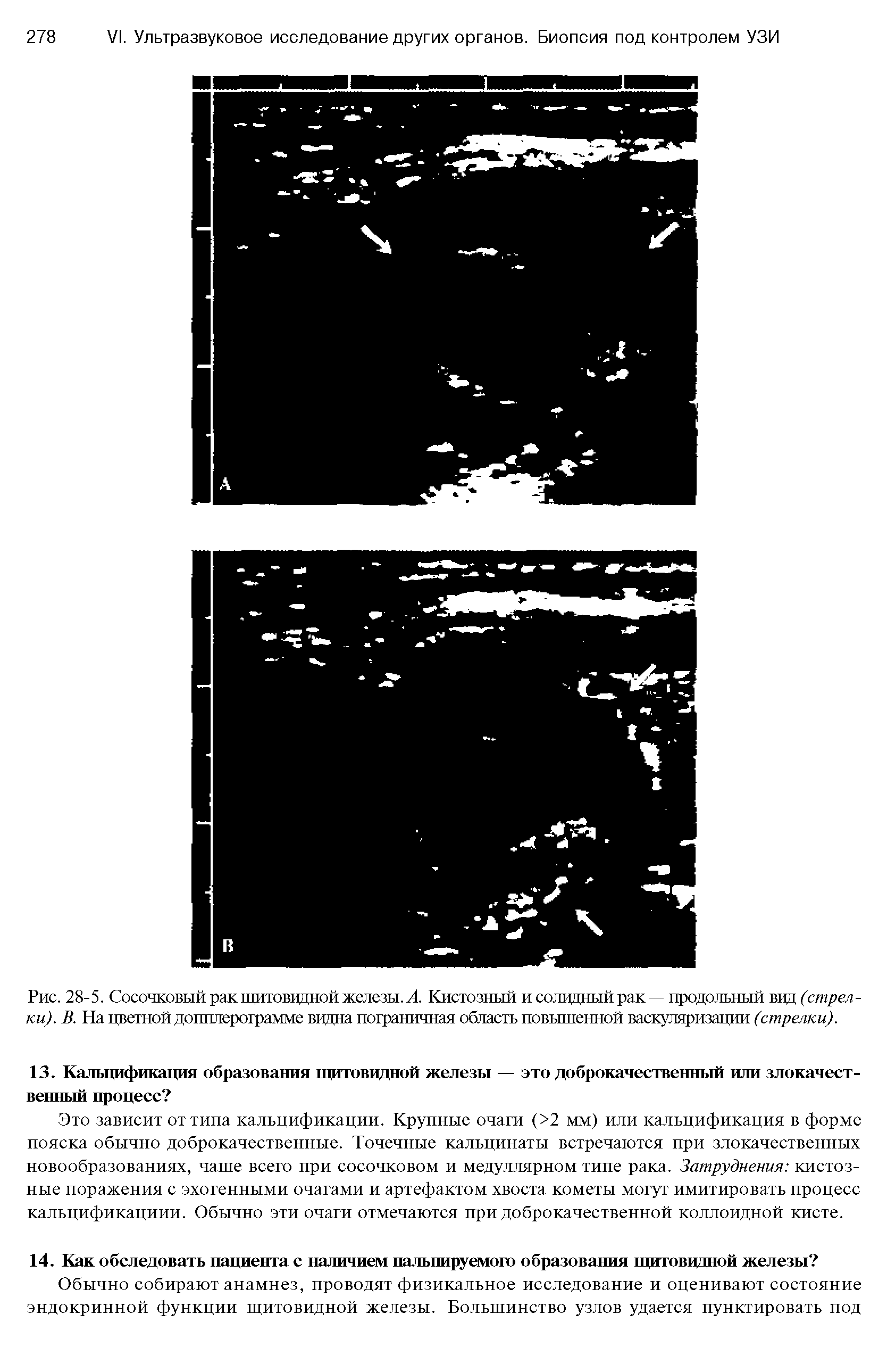 Рис. 28-5. Сосочковый рак щитовидной железы. Л. Кистозный и солидный рак — продольный вид (стрелки). В. На цветной допплерограмме видна пограничная область повышенной васкуляризации (стрелки).