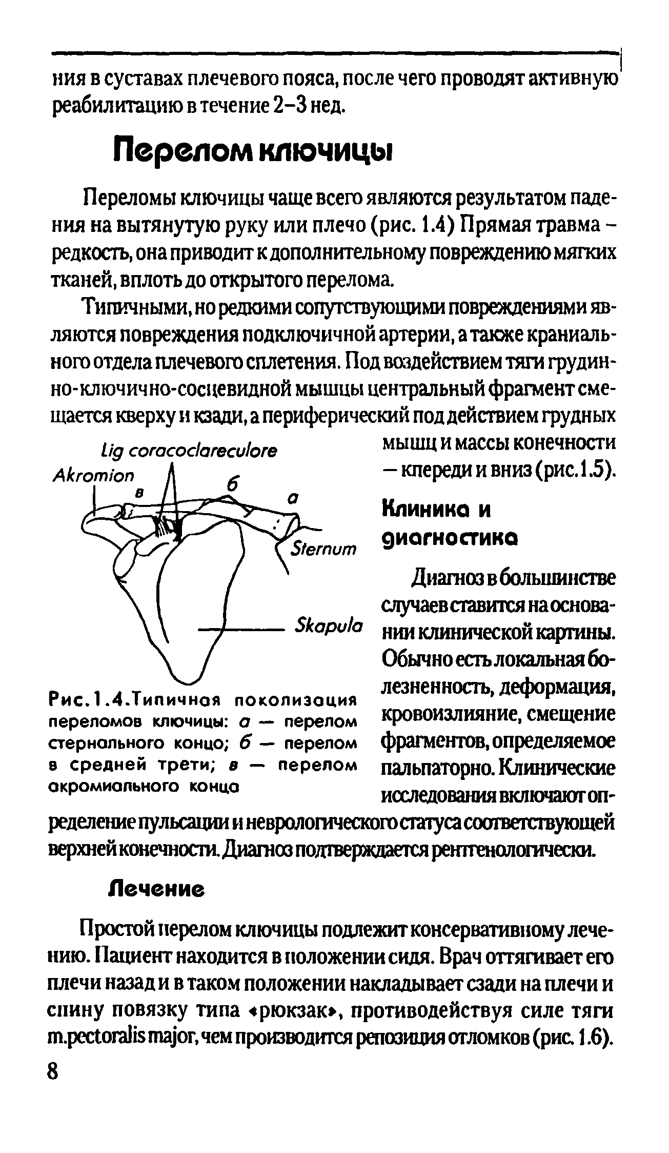 Рис.1.4.Типичная локализация переломов ключицы а — перелом стернального концо б — перелом в средней трети в — перелом акромиального конца...