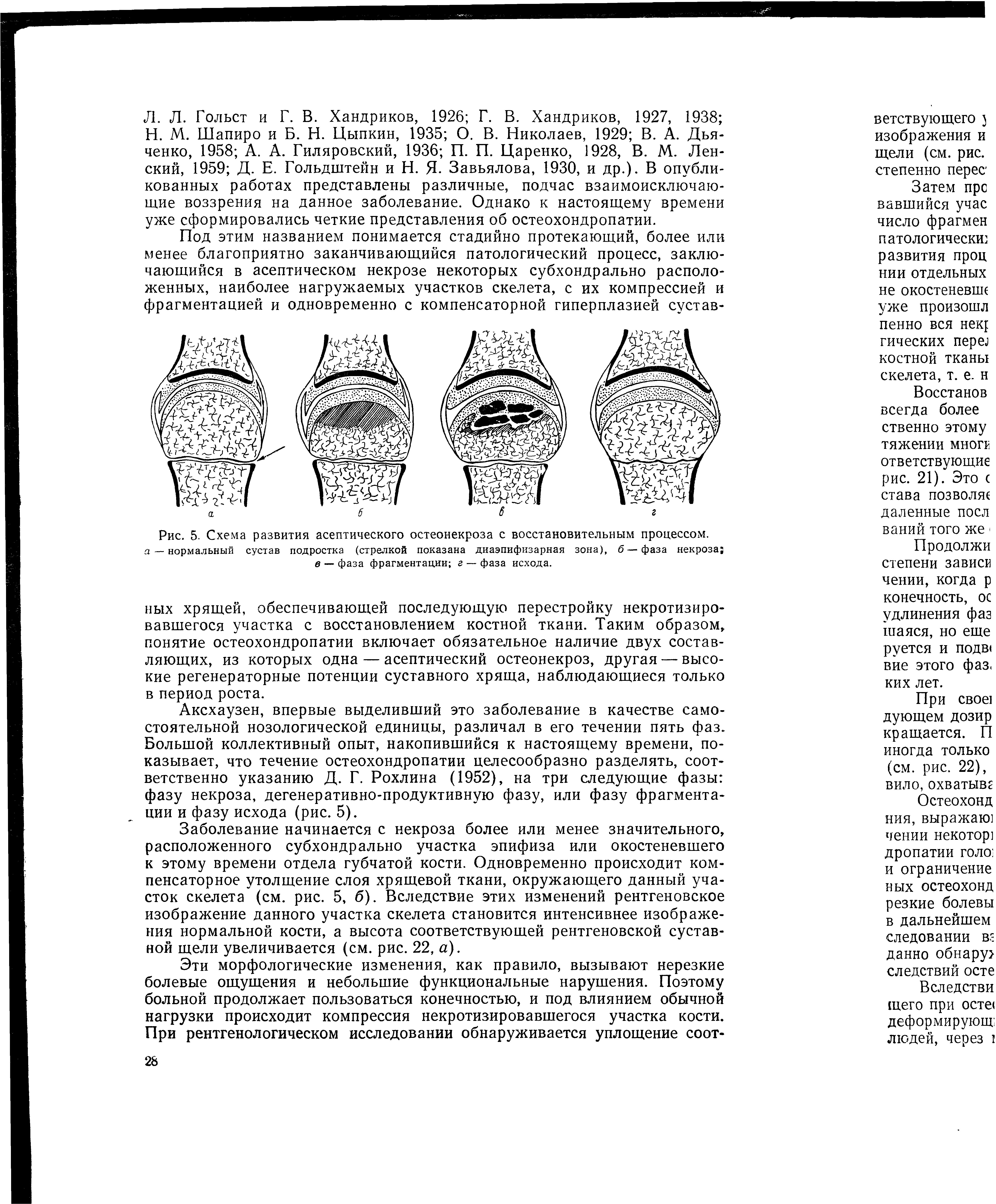 Рис. 5. Схема развития асептического остеонекроза с восстановительным процессом. а — нормальный сустав подростка (стрелкой показана диаэпифизарная зона), б — фаза некроза в — фаза фрагментации г — фаза исхода.