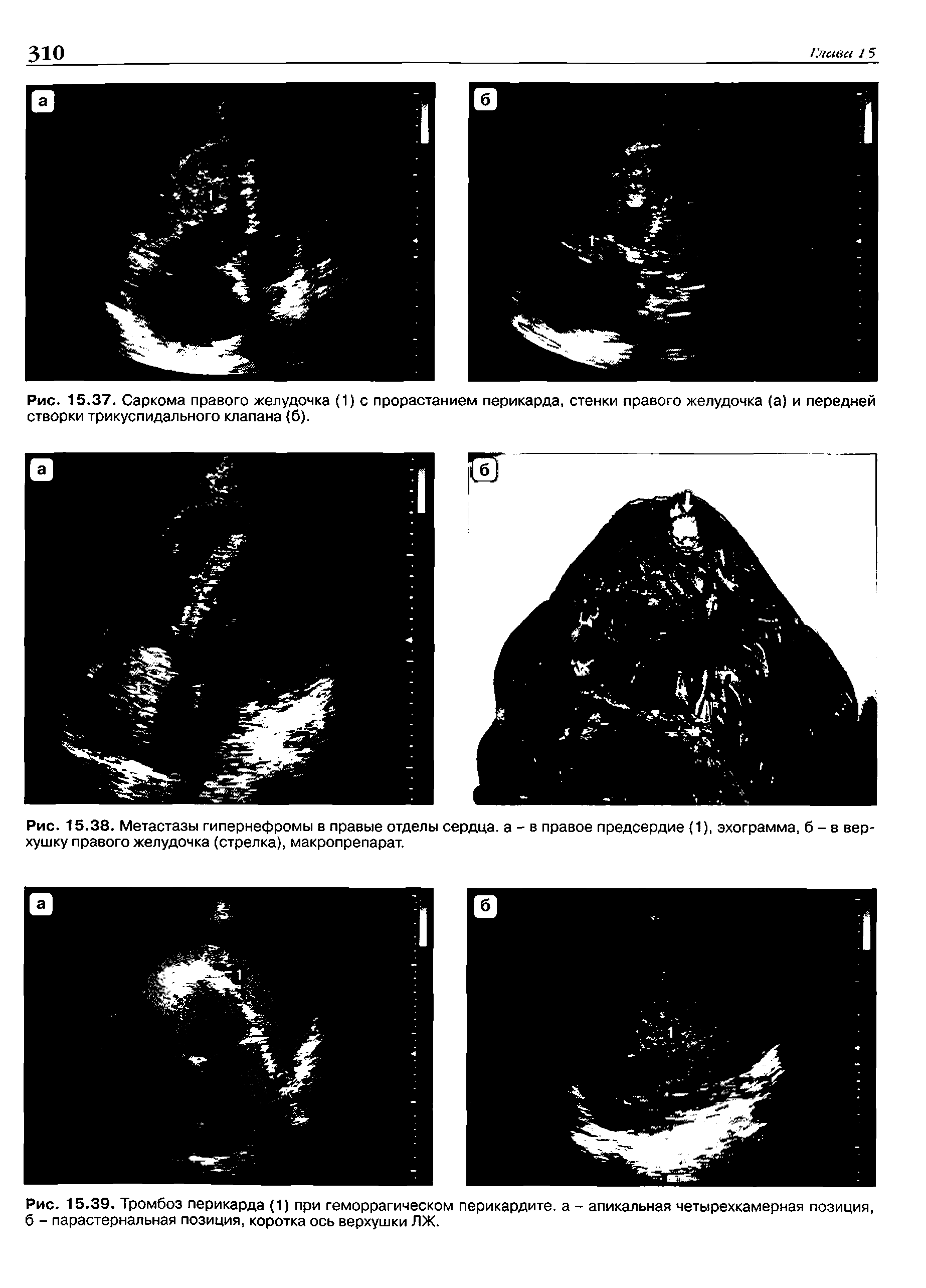 Рис. 15.39. Тромбоз перикарда (1) при геморрагическом перикардите, а - апикальная четырехкамерная позиция б - парастернальная позиция, коротка ось верхушки ЛЖ.