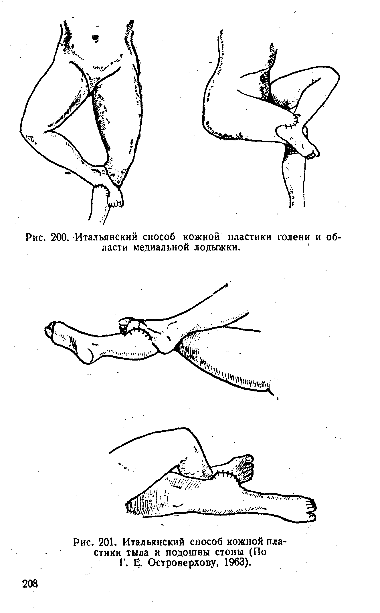 Рис. 201. Итальянский способ кожной пластики тыла и подошвы стопы (По Г. Е. Островерхову, 1963).